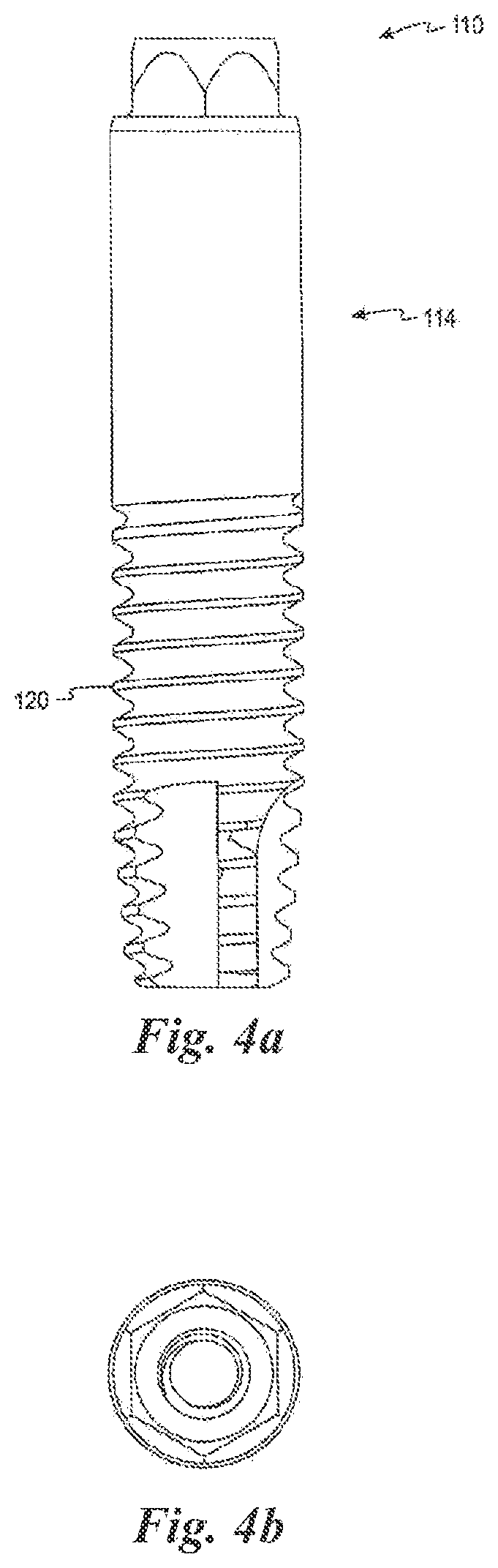 Patent US12588981 Figure 4 – Surface treatment for an implant surface