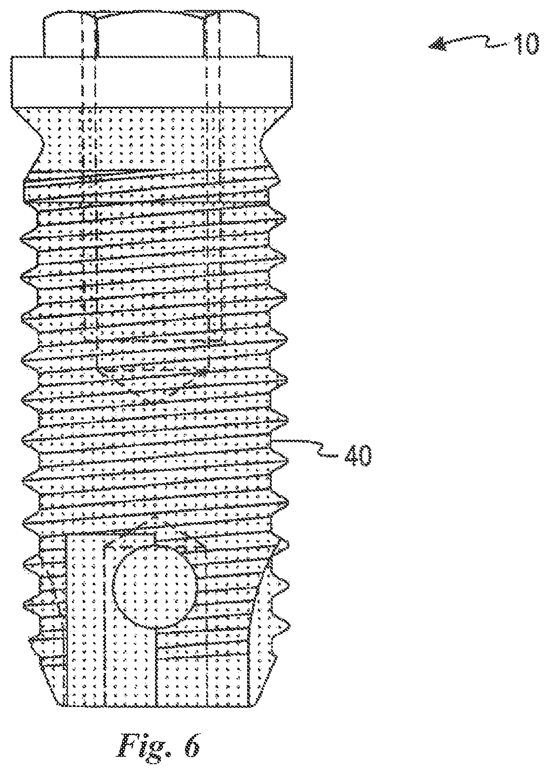 Patent US12588981 Figure 6 – Surface treatment for an implant surface
