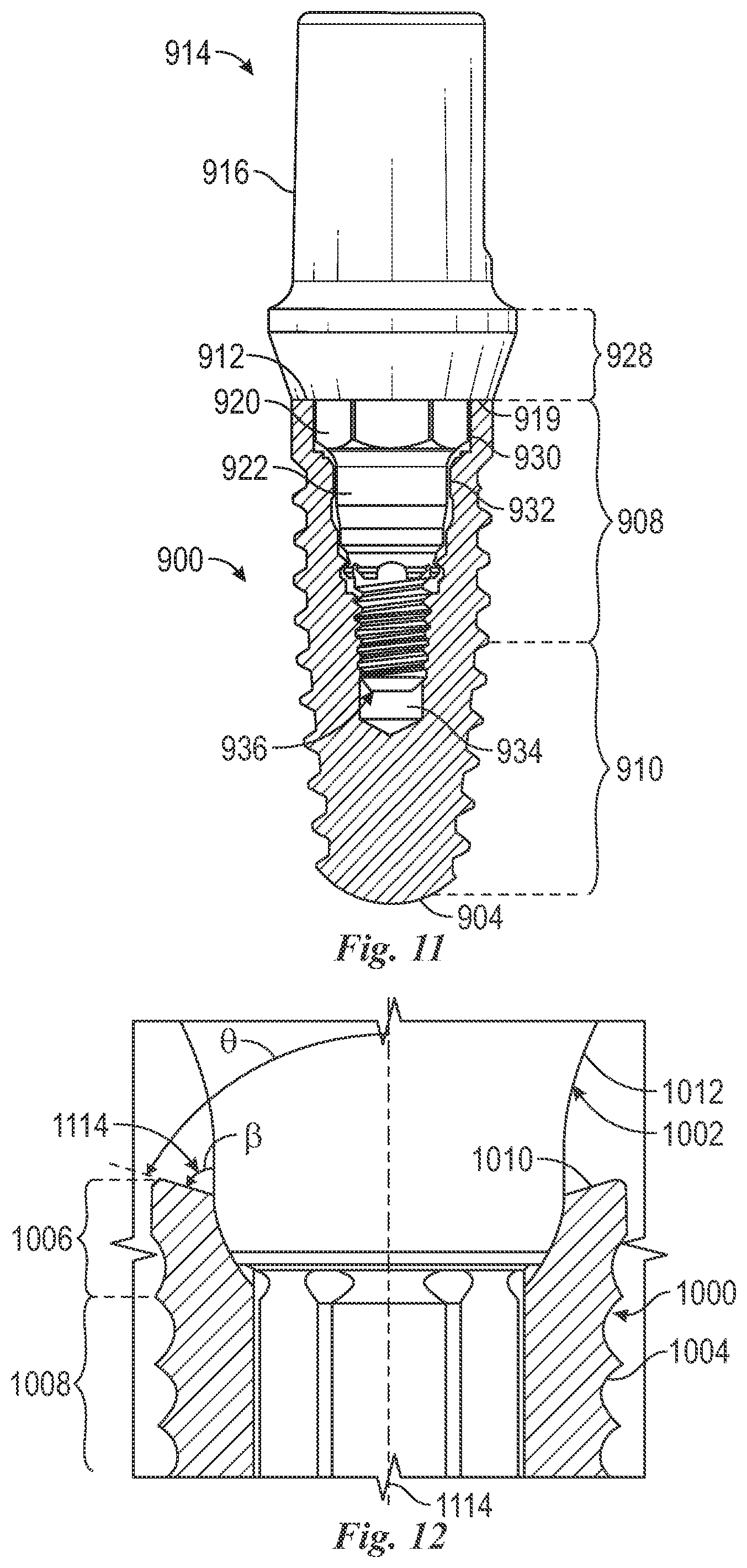 Patent US12588981 Figure 11 – Surface treatment for an implant surface
