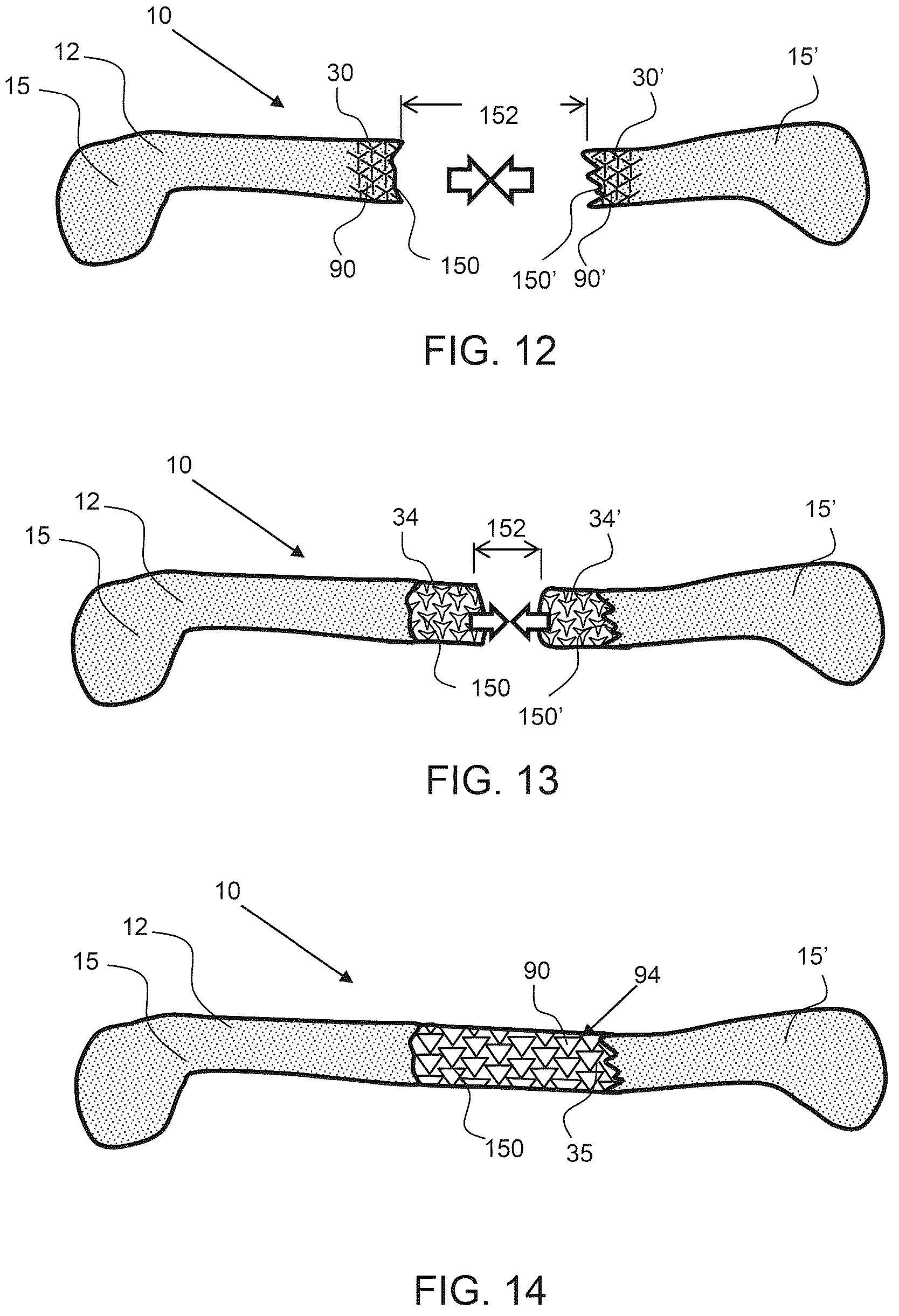 Patent US12588985 Figure 6 – Compliant biological scaffold