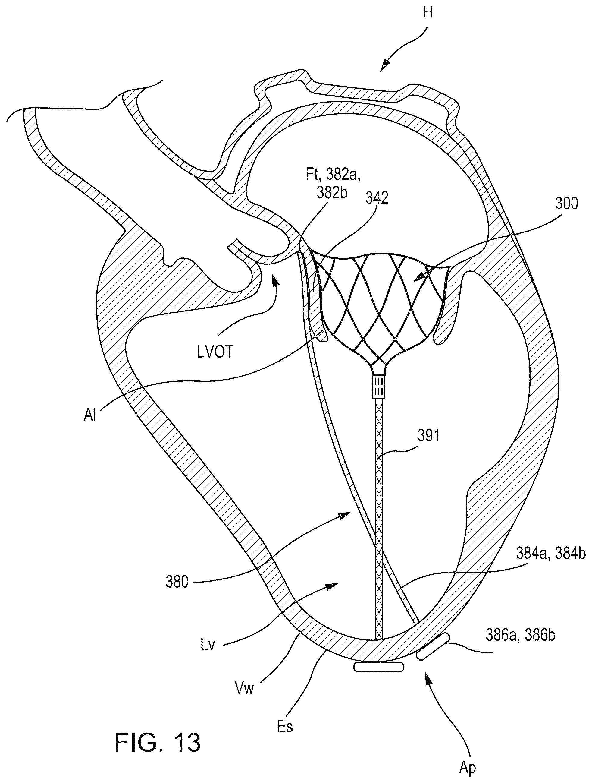 Patent US12588986 Figure 11 – Apparatus and methods for anterior valve leaflet management
