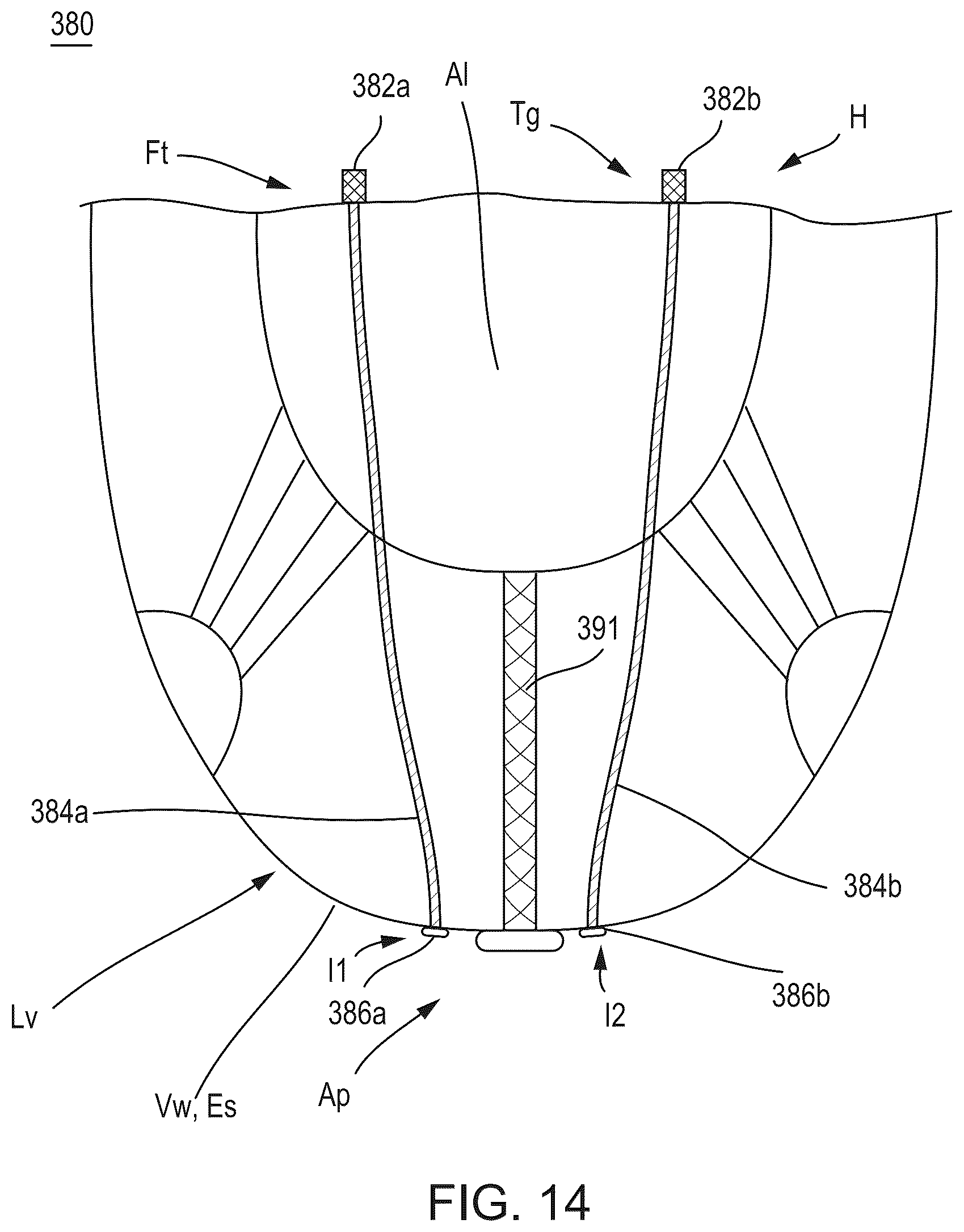 Patent US12588986 Figure 12 – Apparatus and methods for anterior valve leaflet management