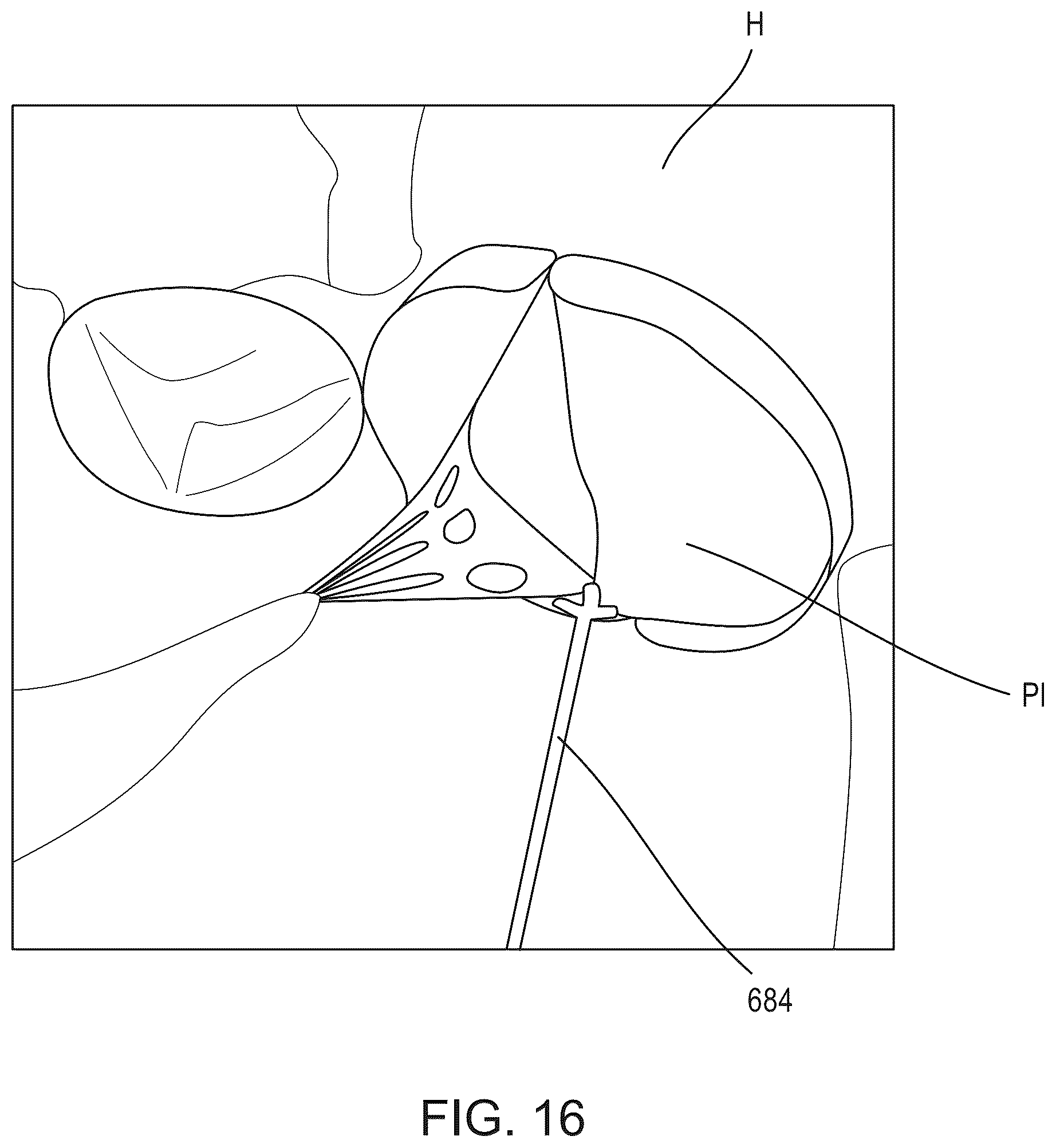 Patent US12588986 Figure 14 – Apparatus and methods for anterior valve leaflet management