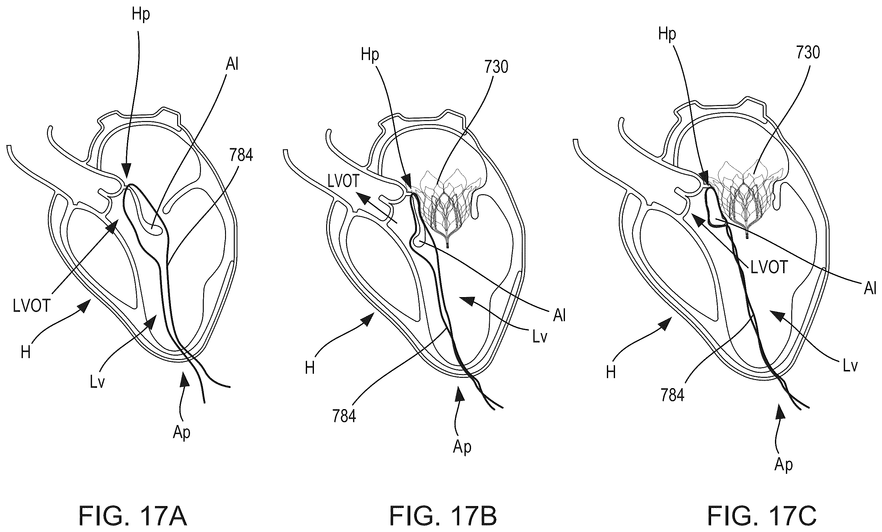 Patent US12588986 Figure 15 – Apparatus and methods for anterior valve leaflet management