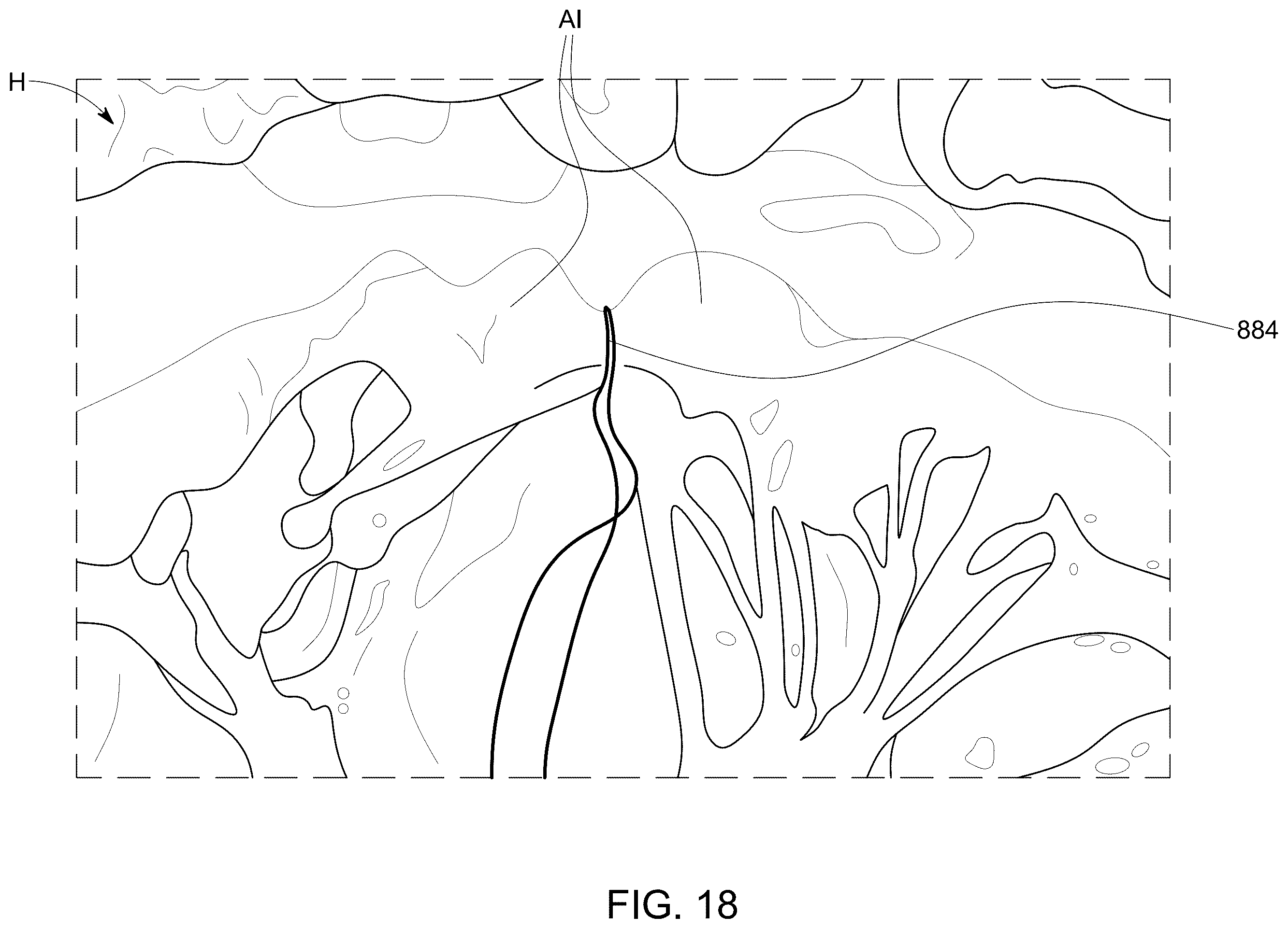 Patent US12588986 Figure 16 – Apparatus and methods for anterior valve leaflet management