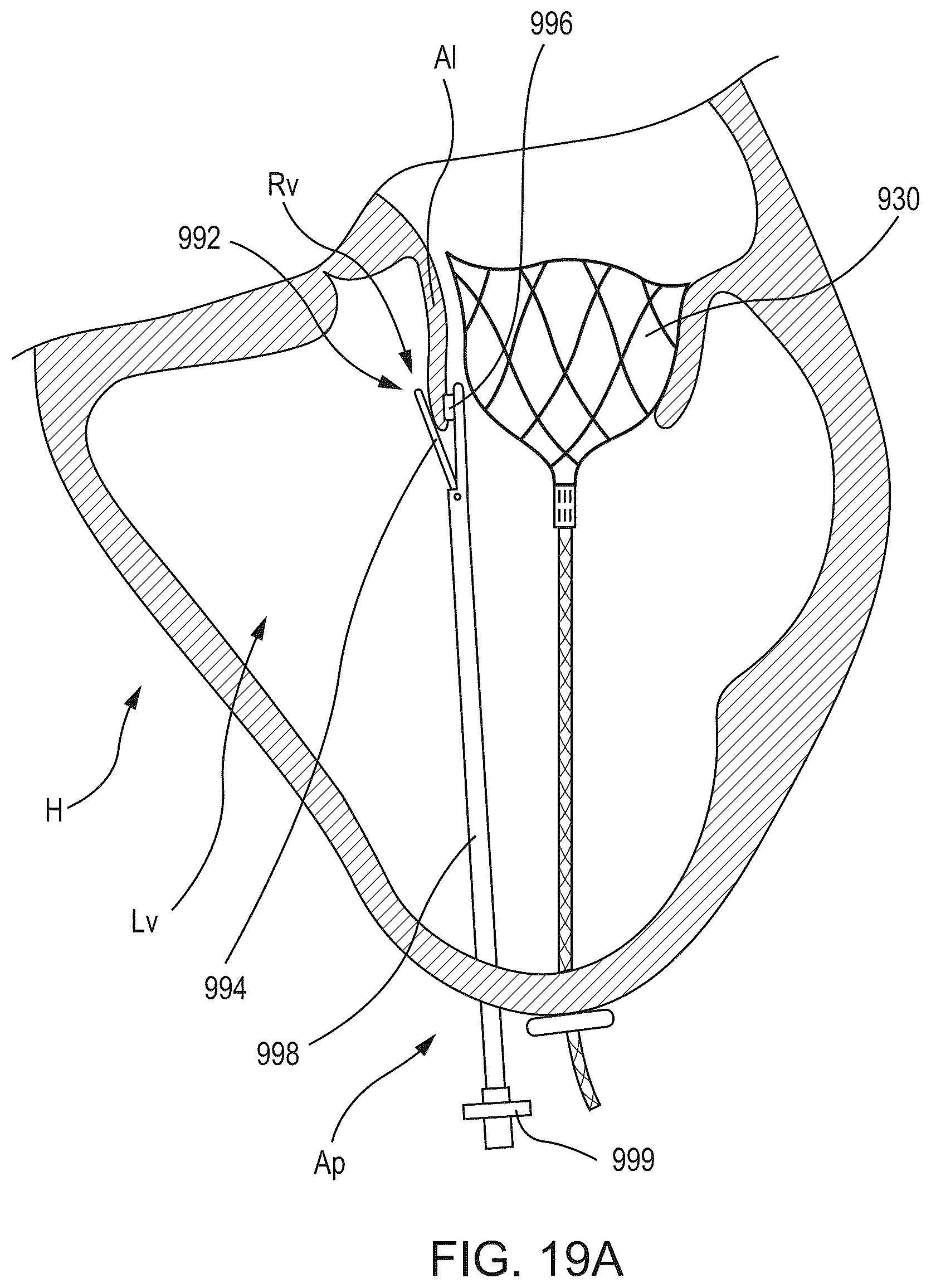 Patent US12588986 Figure 17 – Apparatus and methods for anterior valve leaflet management
