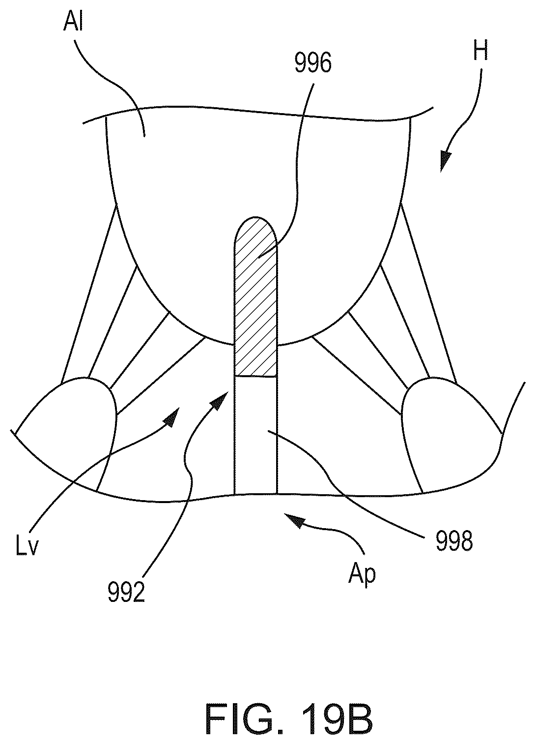 Patent US12588986 Figure 18 – Apparatus and methods for anterior valve leaflet management