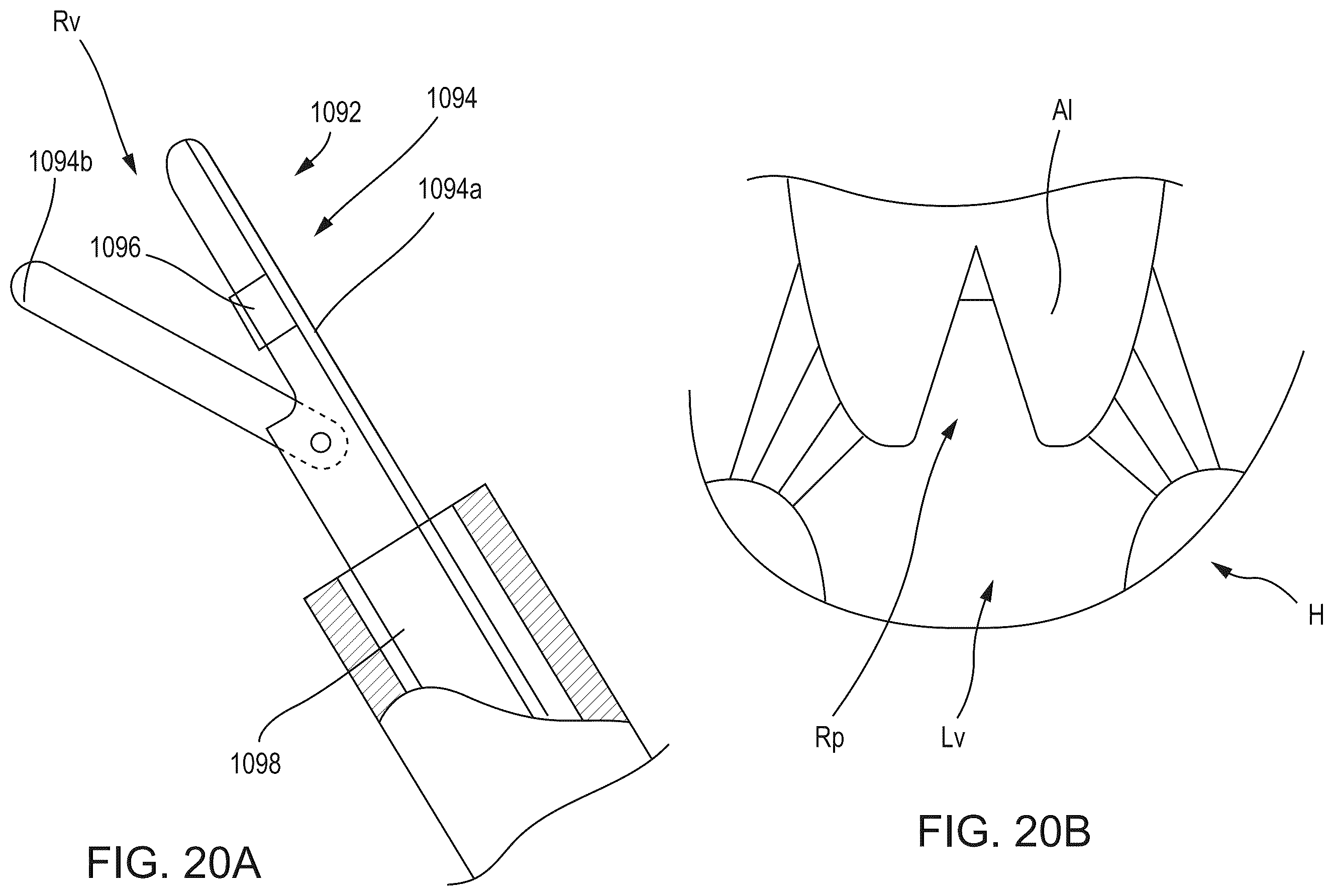 Patent US12588986 Figure 19 – Apparatus and methods for anterior valve leaflet management