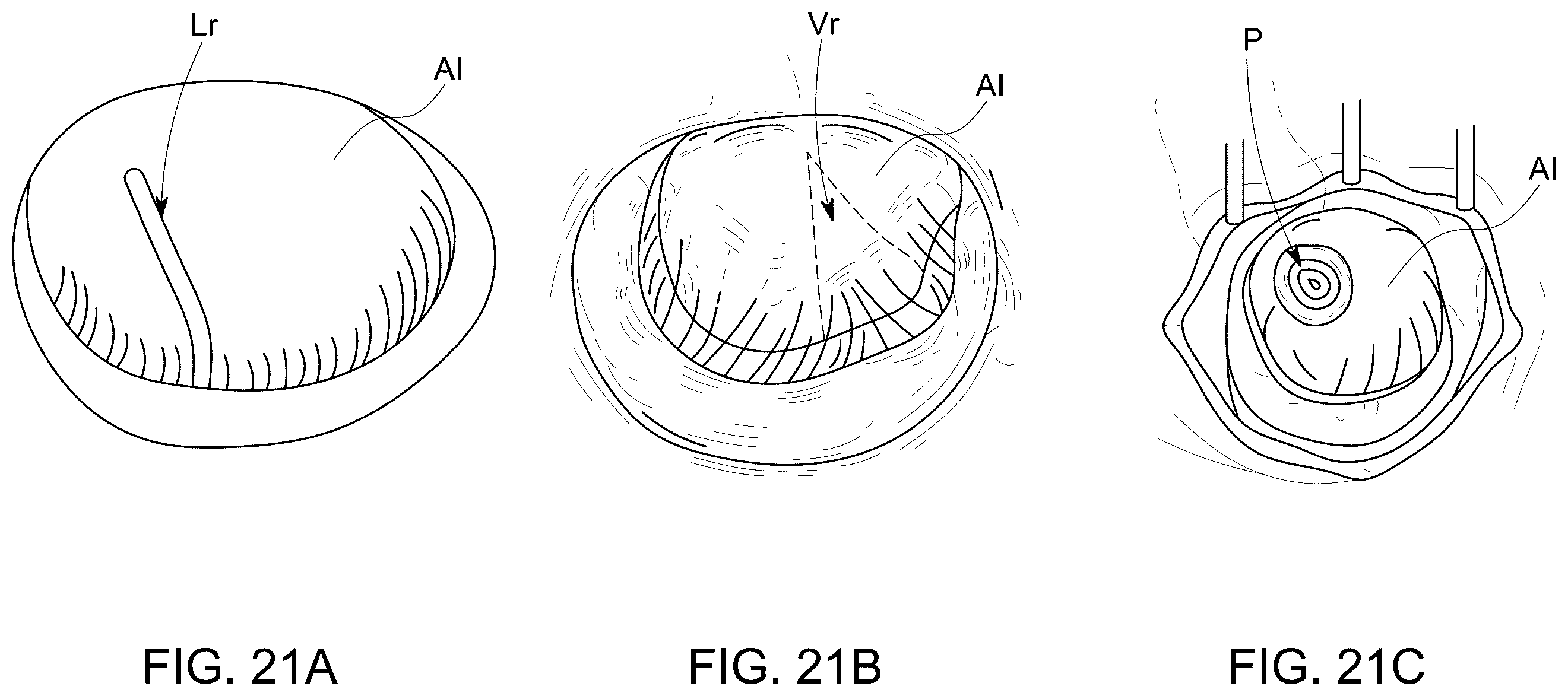 Patent US12588986 Figure 20 – Apparatus and methods for anterior valve leaflet management