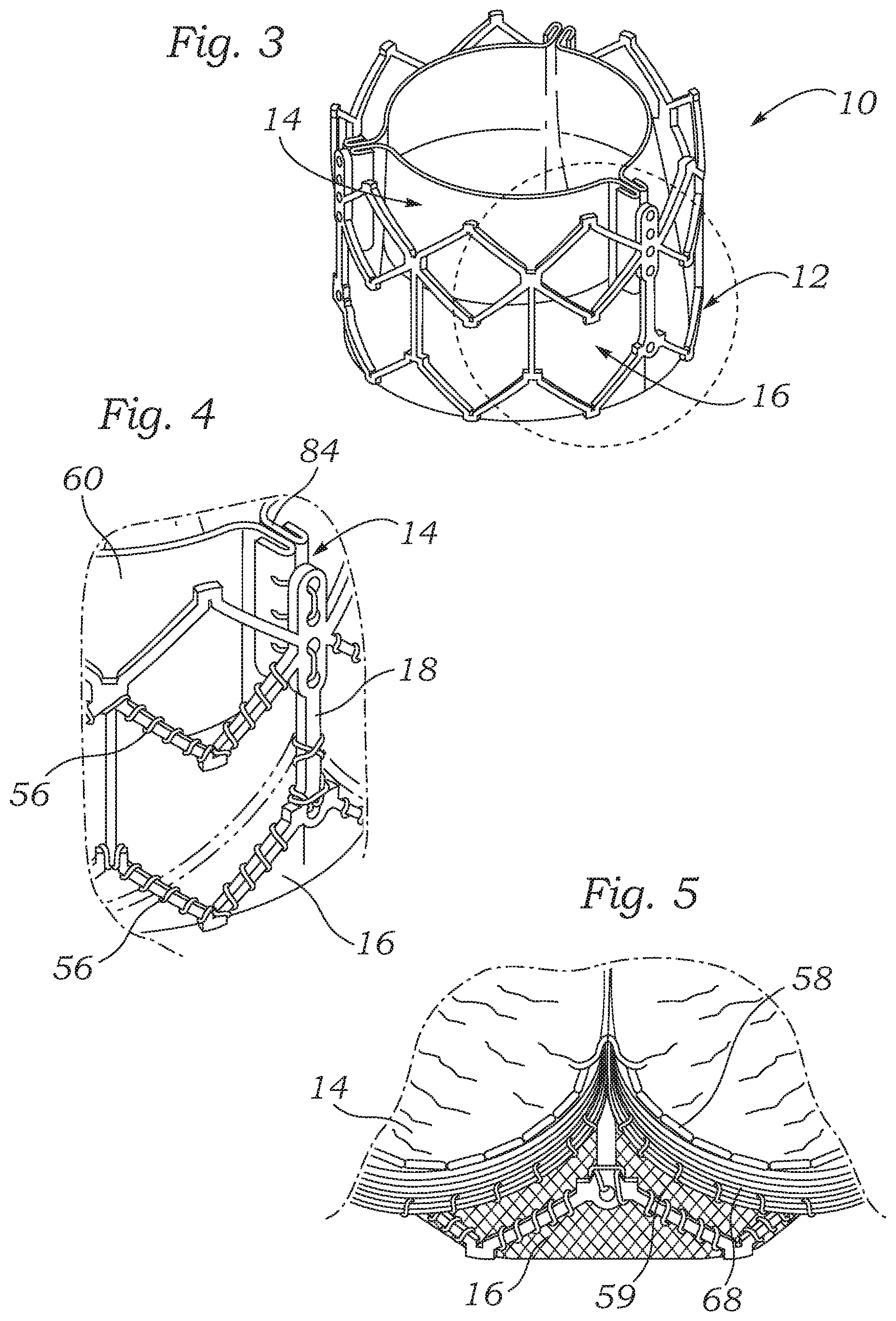 Patent US12588987 Figure 2 – Low profile transcatheter heart valve