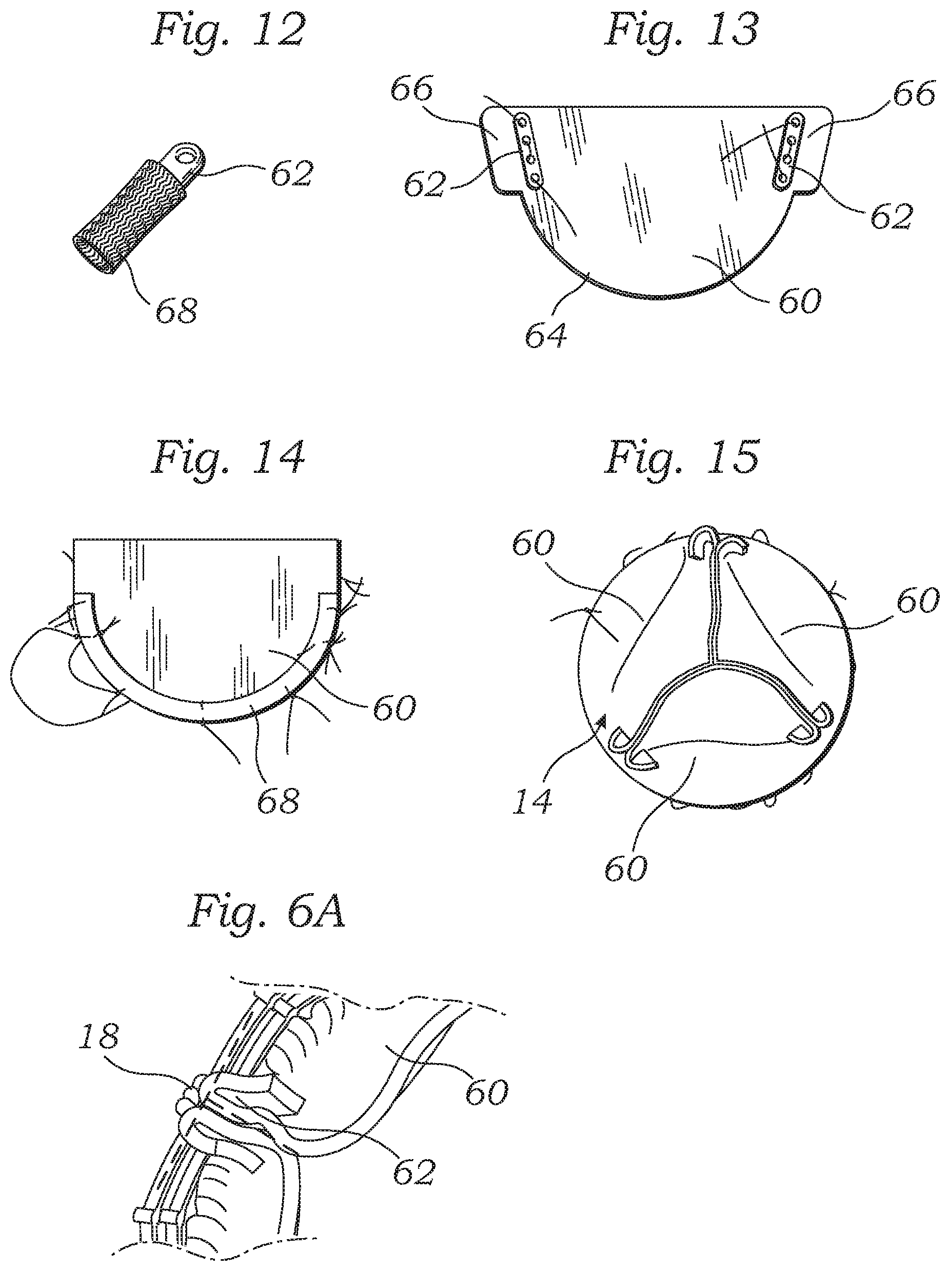 Patent US12588987 Figure 4 – Low profile transcatheter heart valve