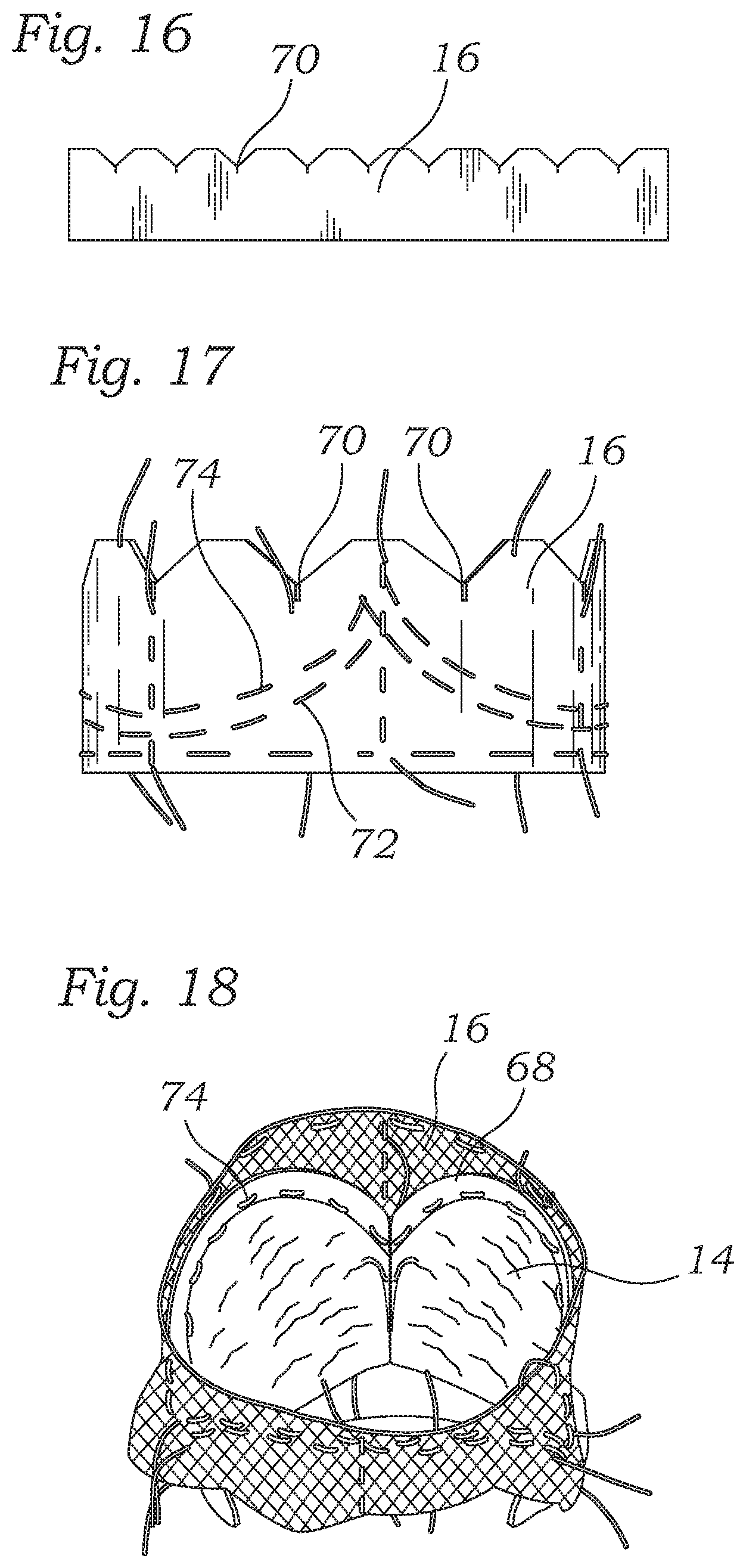 Patent US12588987 Figure 7 – Low profile transcatheter heart valve