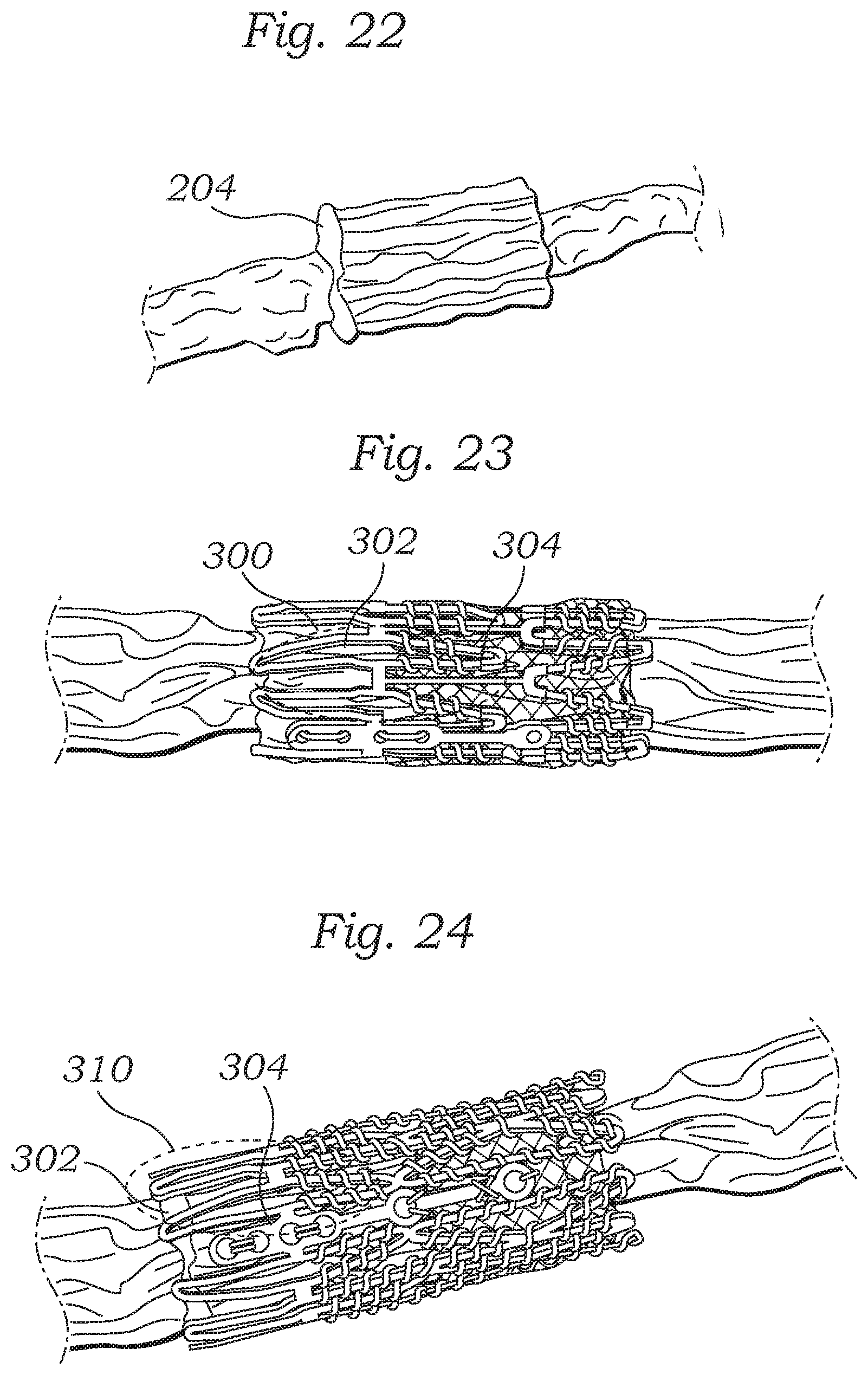 Patent US12588987 Figure 9 – Low profile transcatheter heart valve