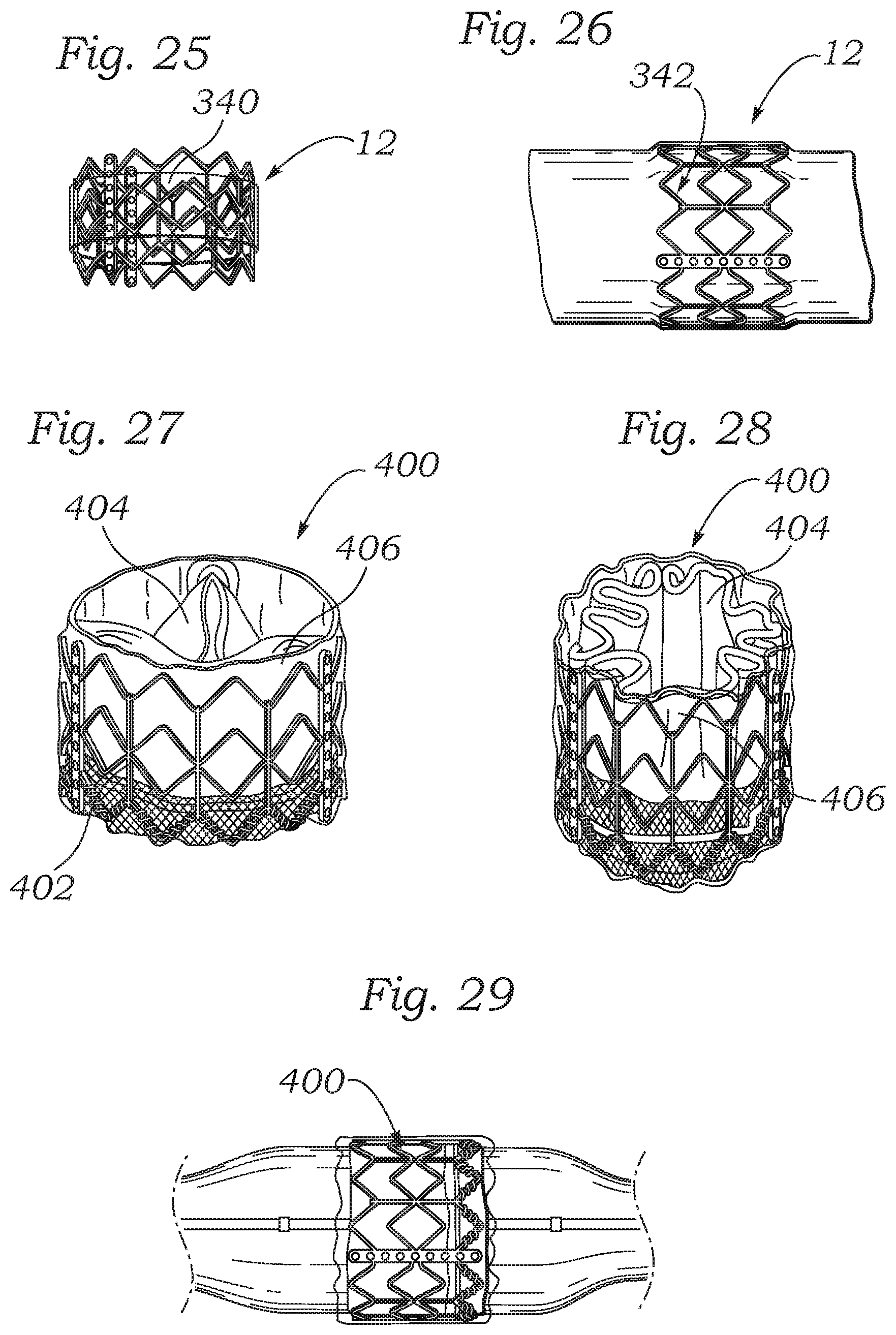 Patent US12588987 Figure 10 – Low profile transcatheter heart valve