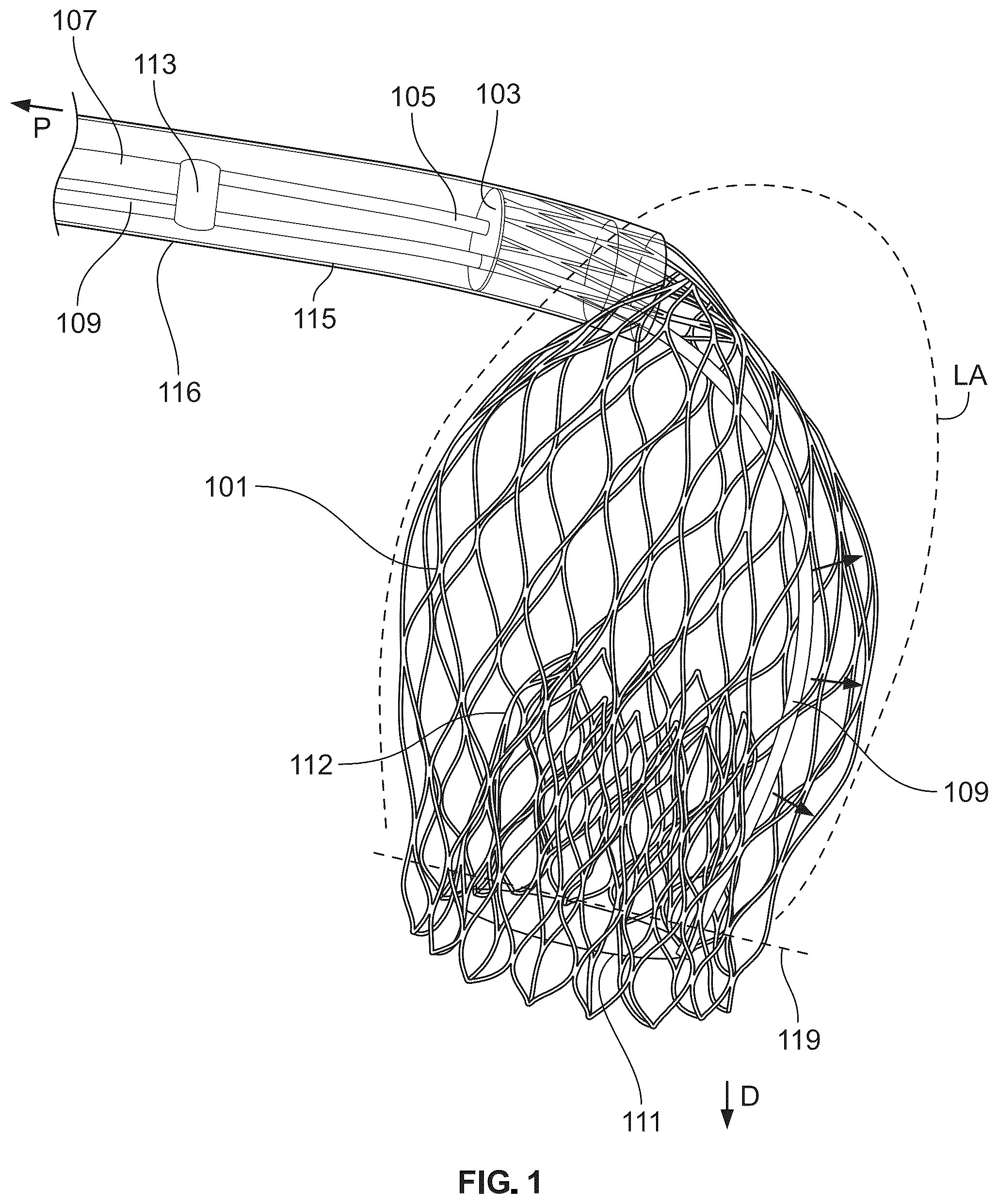 Patent US12588988 Figure 1 – Implant delivery