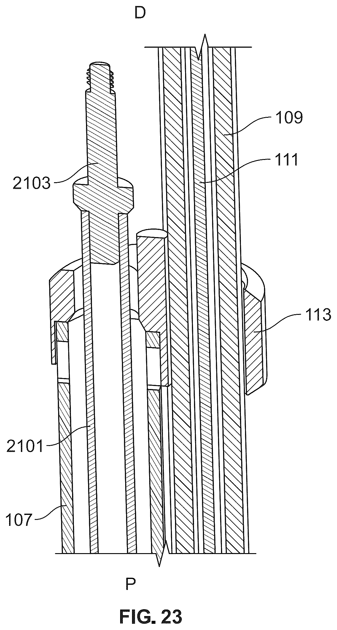Patent US12588988 Figure 17 – Implant delivery