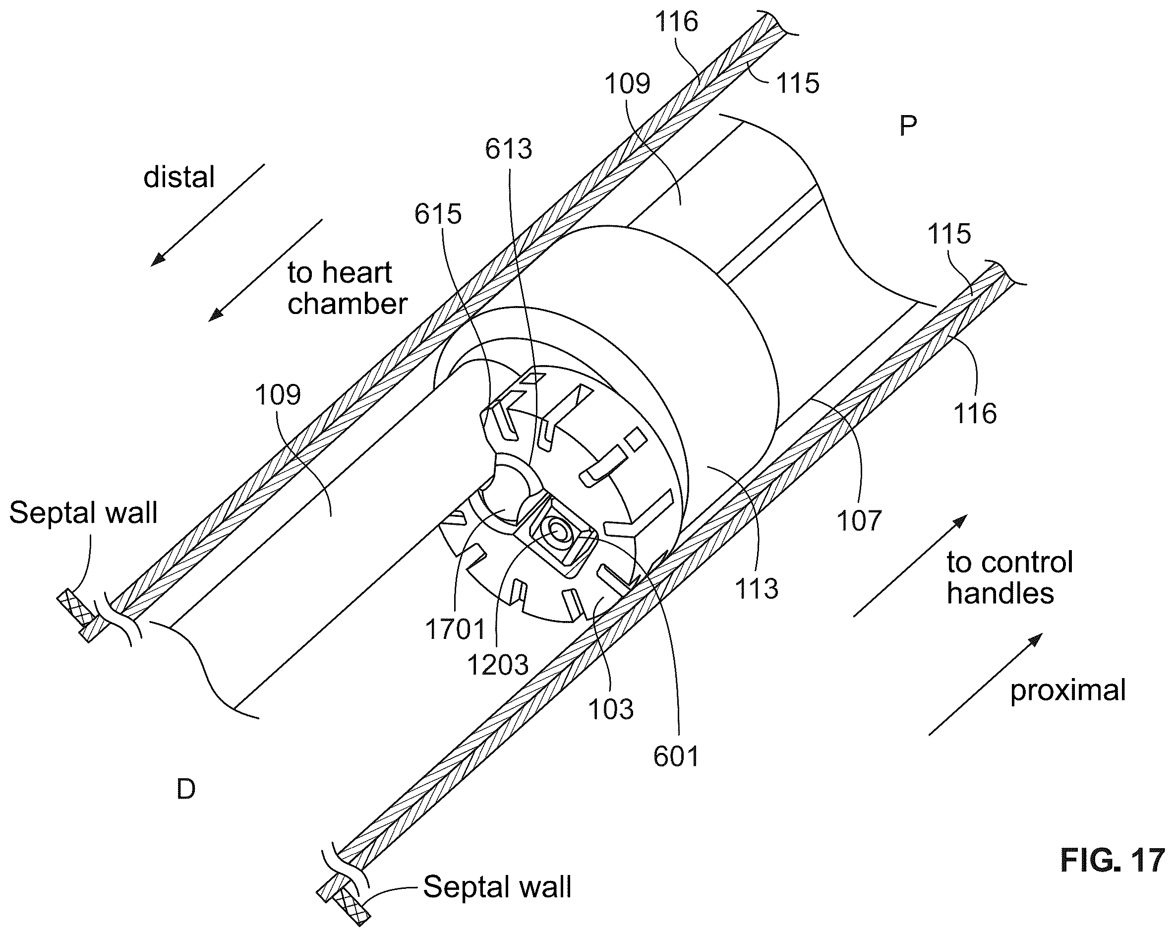 Patent US12588989 Figure 14 – Implant delivery