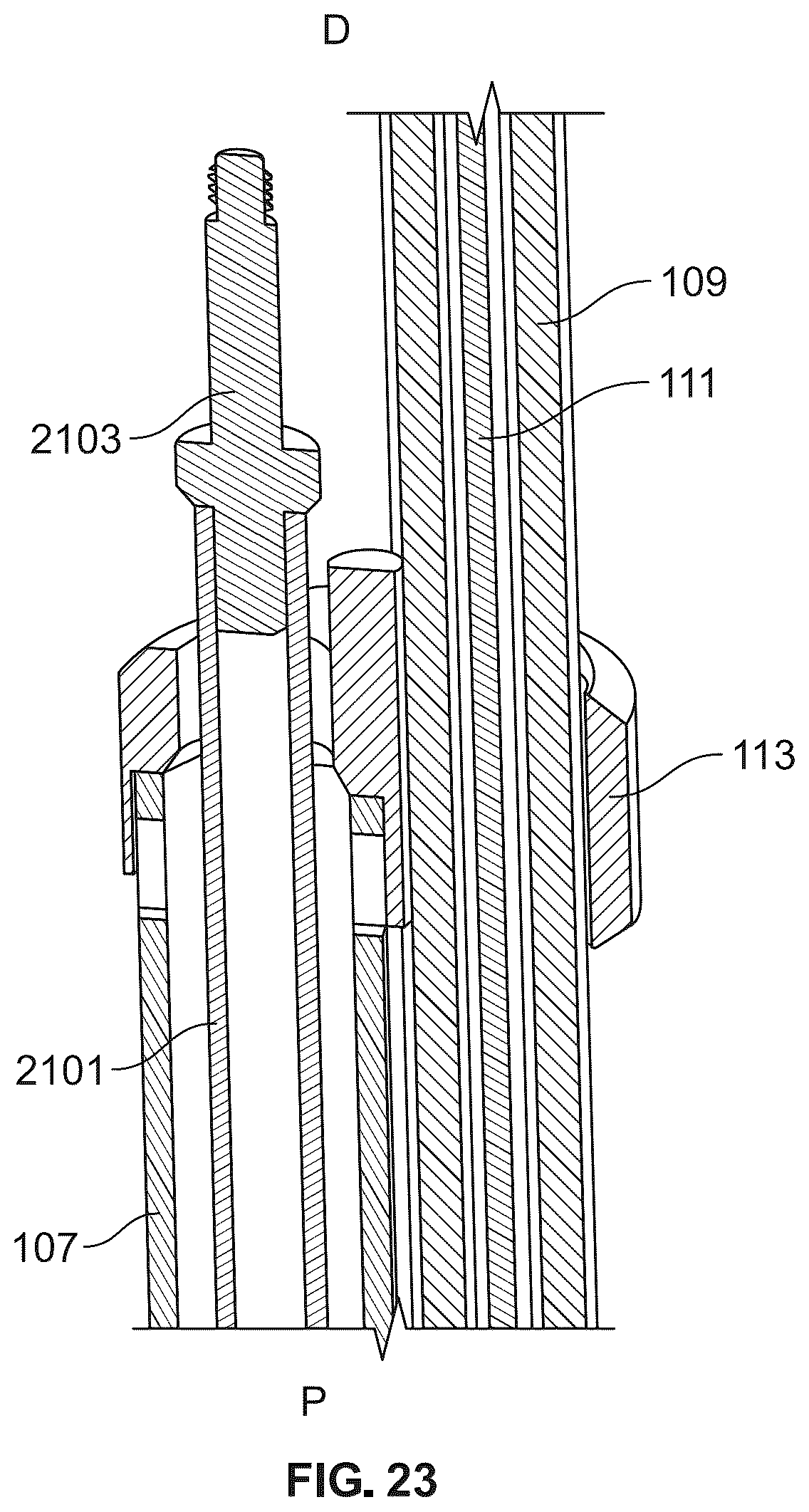 Patent US12588989 Figure 17 – Implant delivery