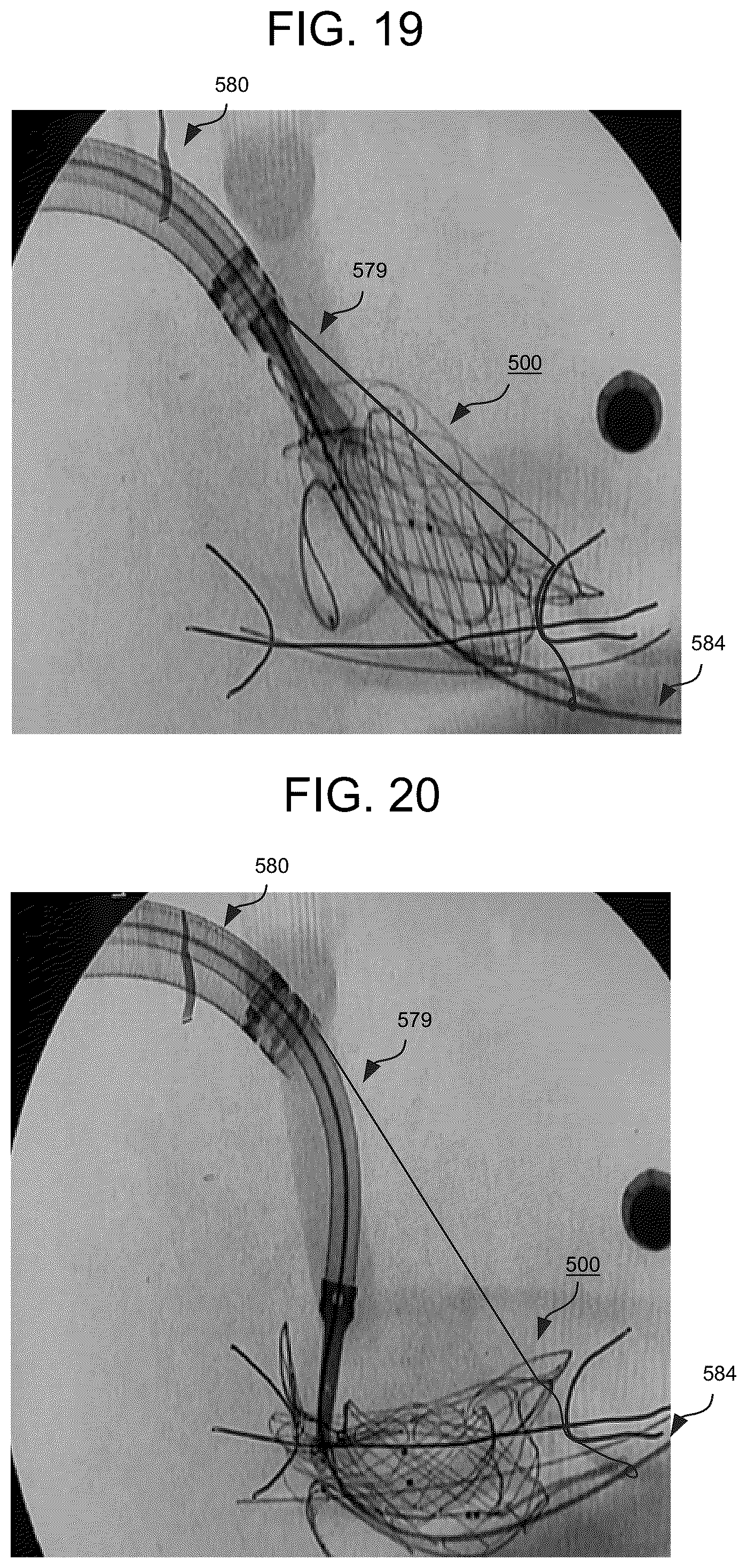 Patent US12588993 Figure 11 – Devices and methods for delivering a prosthetic heart valve using supra-annular support