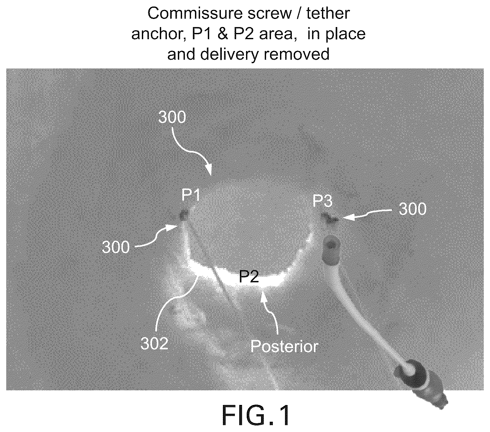 Patent US12588994 Figure 1 – Devices, systems and methods for repairing lumenal systems