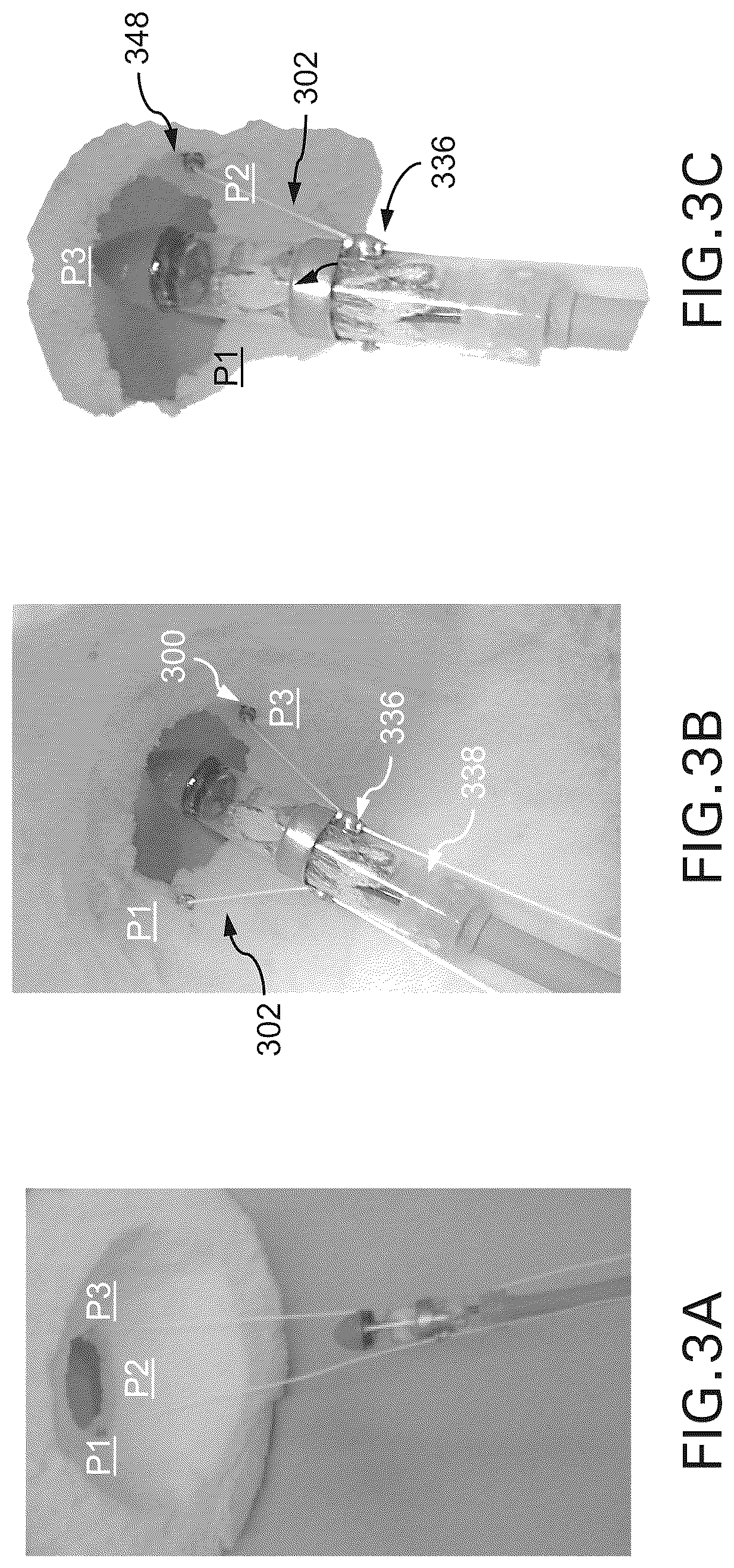 Patent US12588994 Figure 3 – Devices, systems and methods for repairing lumenal systems