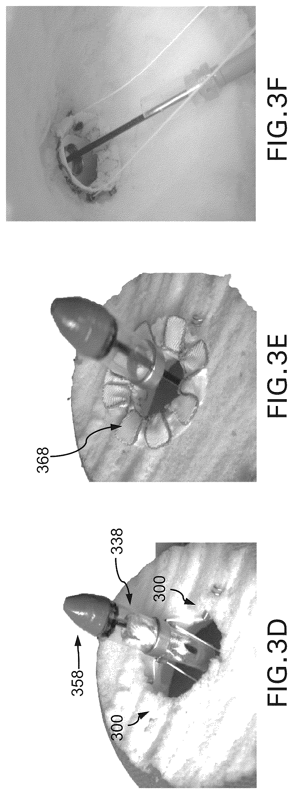 Patent US12588994 Figure 4 – Devices, systems and methods for repairing lumenal systems