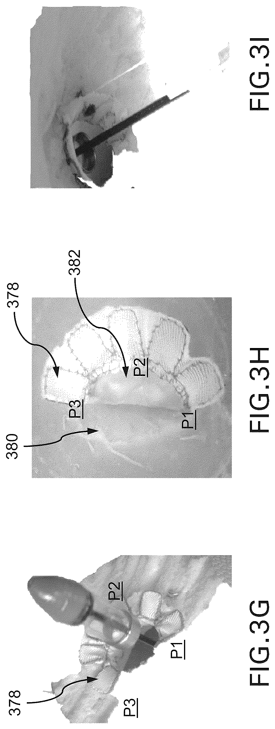Patent US12588994 Figure 5 – Devices, systems and methods for repairing lumenal systems