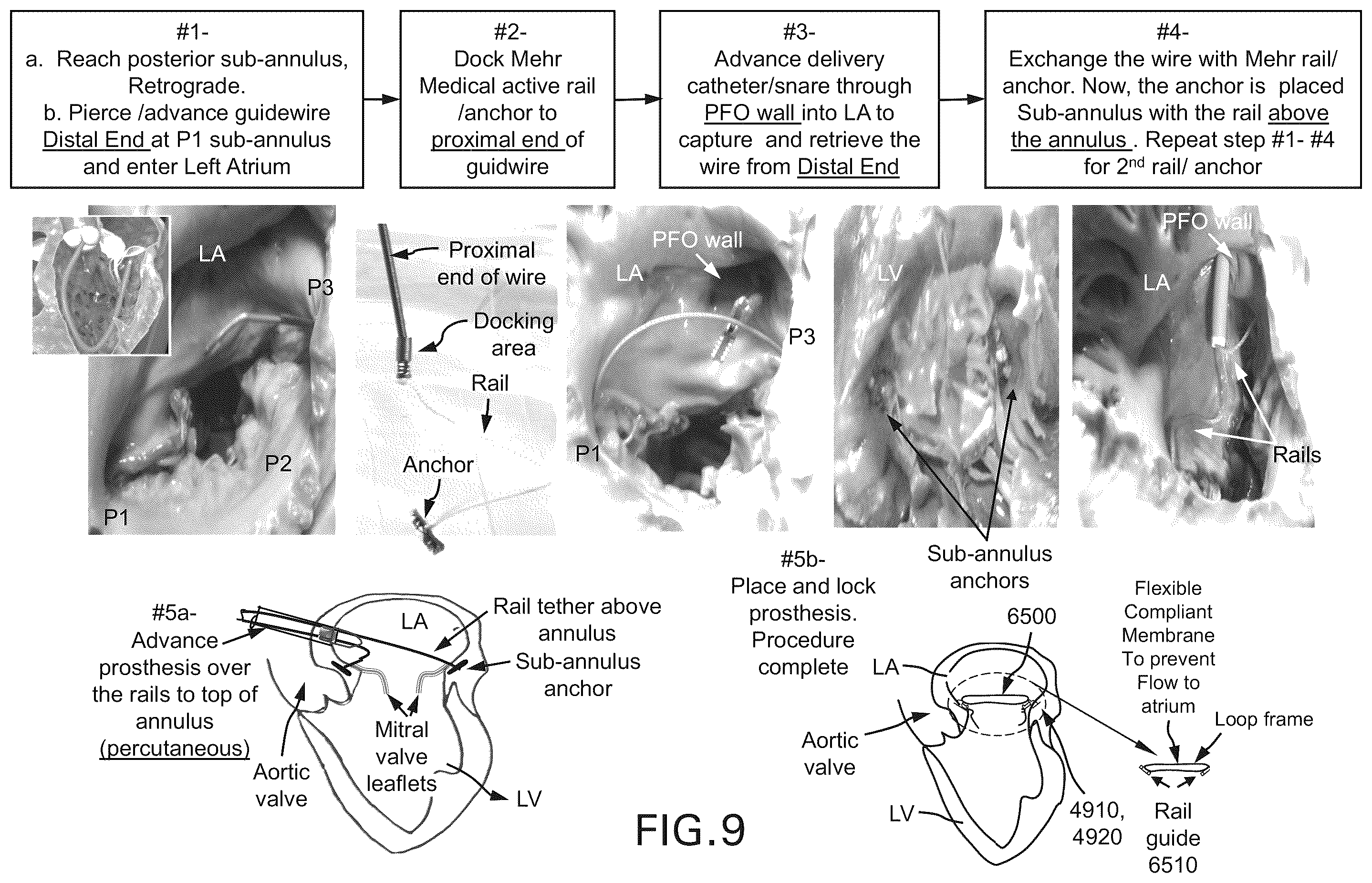 Patent US12588994 Figure 11 – Devices, systems and methods for repairing lumenal systems