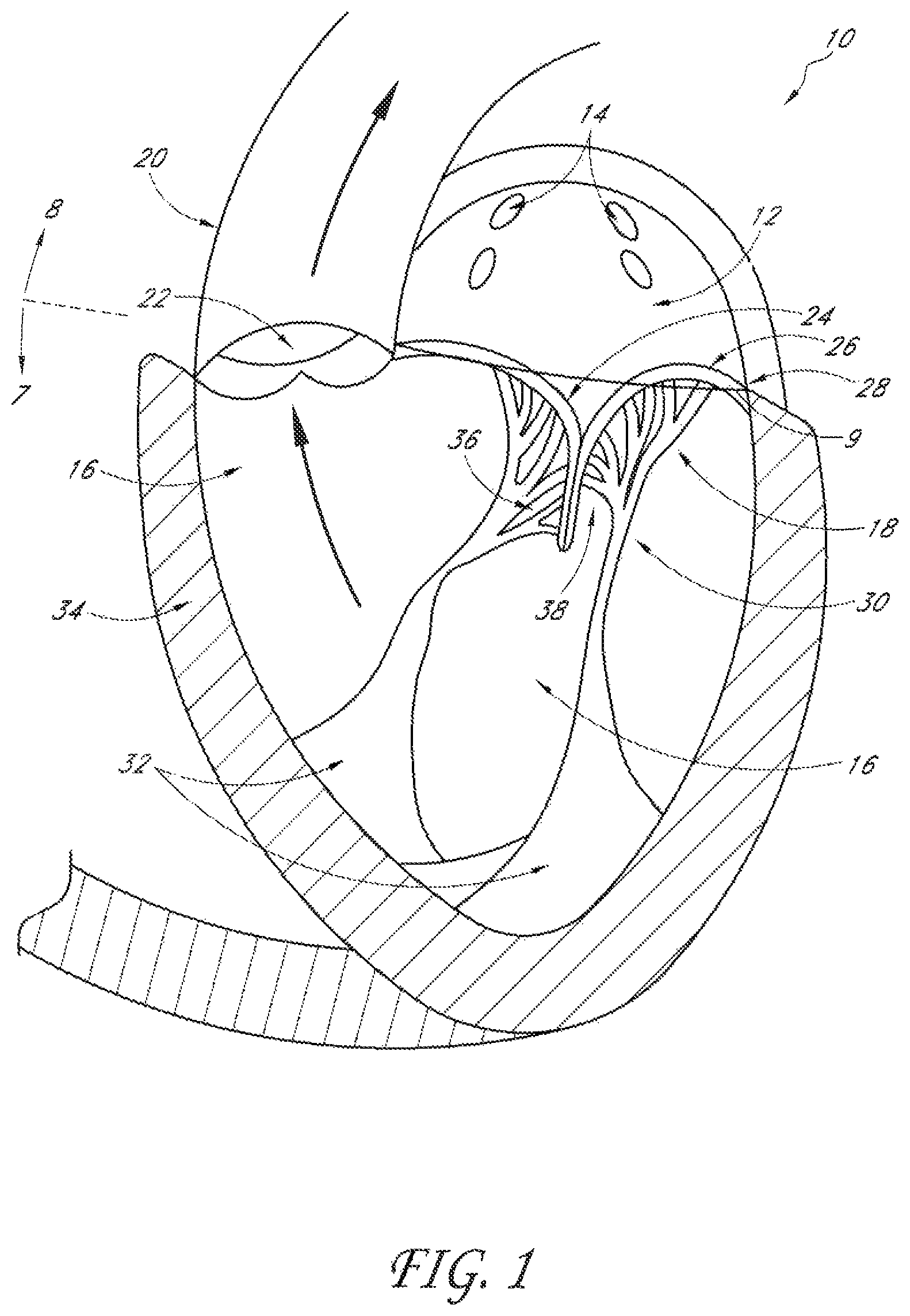 Patent US12588995 Figure 1 – Transvalvular intraanular band and chordae cutting for ischemic and dilated cardiomyopathy