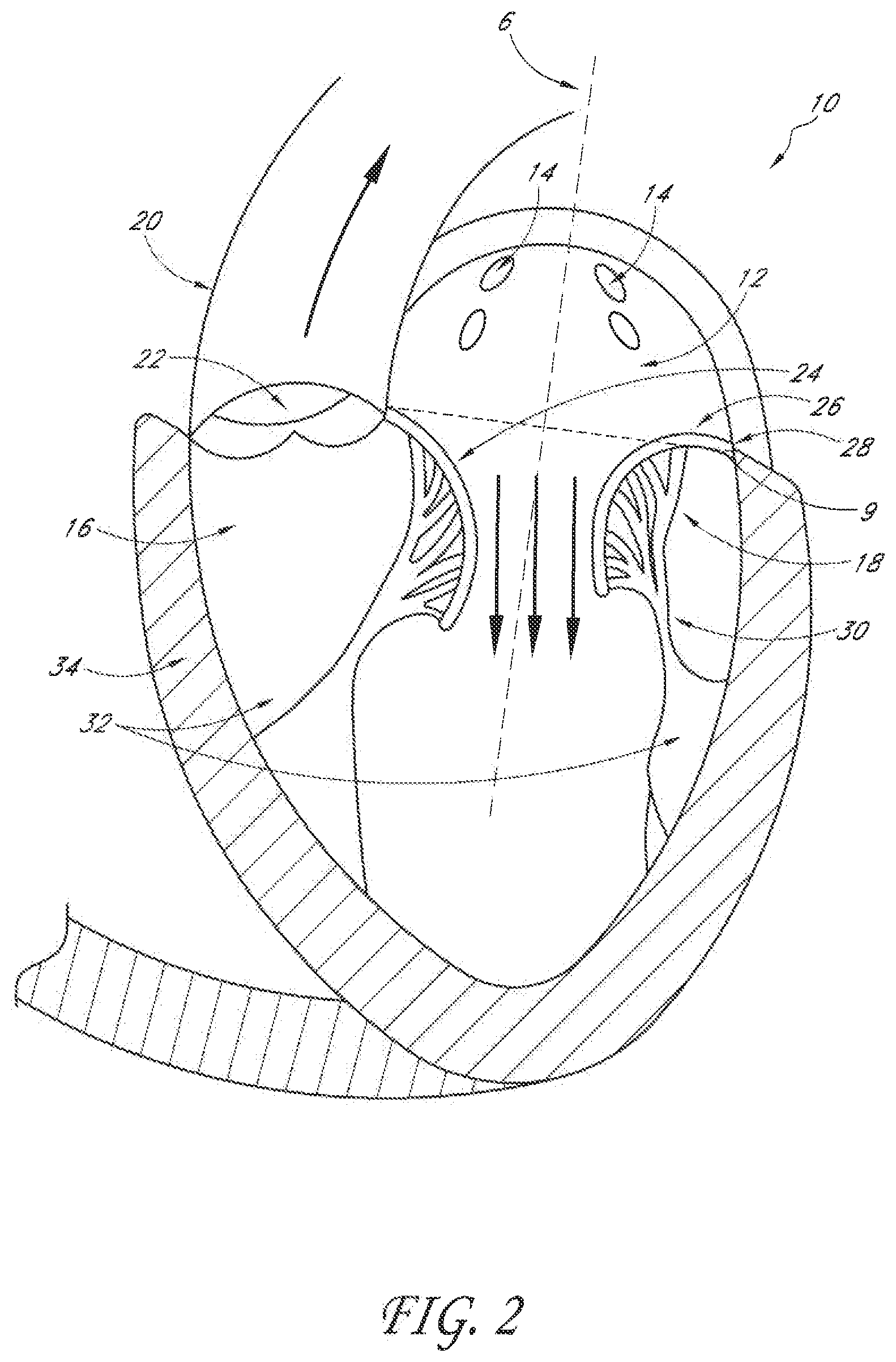 Patent US12588995 Figure 2 – Transvalvular intraanular band and chordae cutting for ischemic and dilated cardiomyopathy