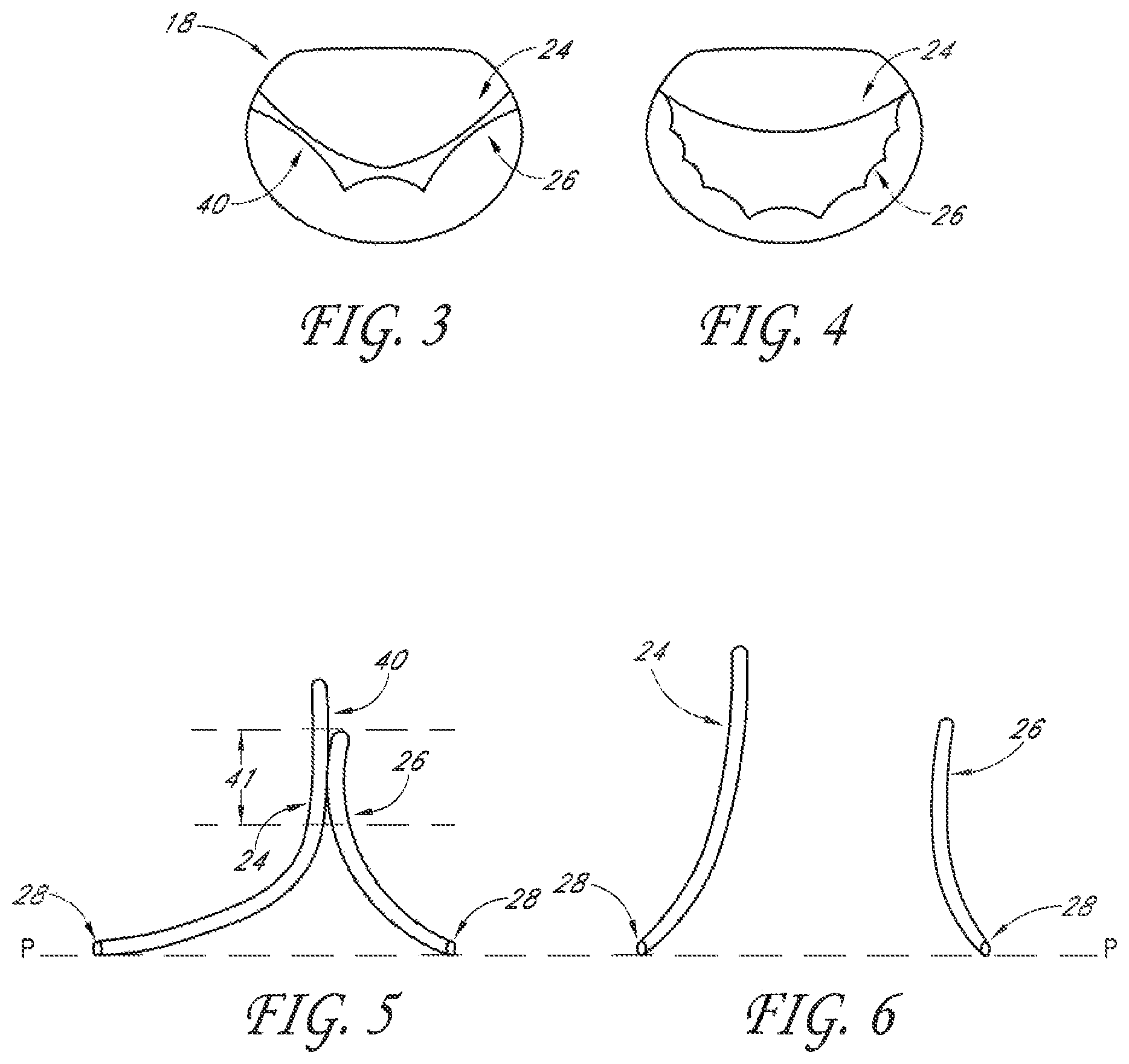Patent US12588995 Figure 3 – Transvalvular intraanular band and chordae cutting for ischemic and dilated cardiomyopathy