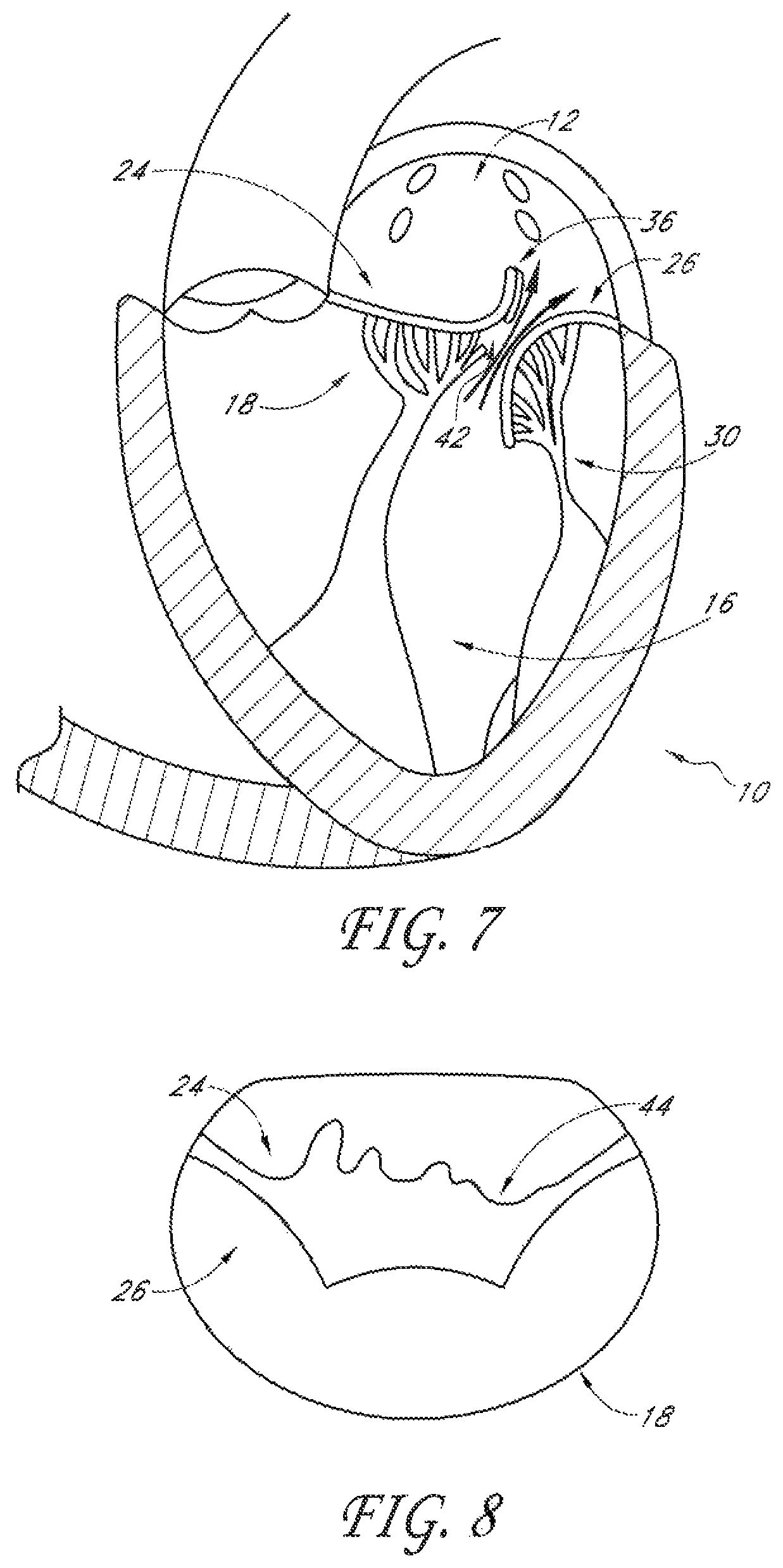 Patent US12588995 Figure 4 – Transvalvular intraanular band and chordae cutting for ischemic and dilated cardiomyopathy