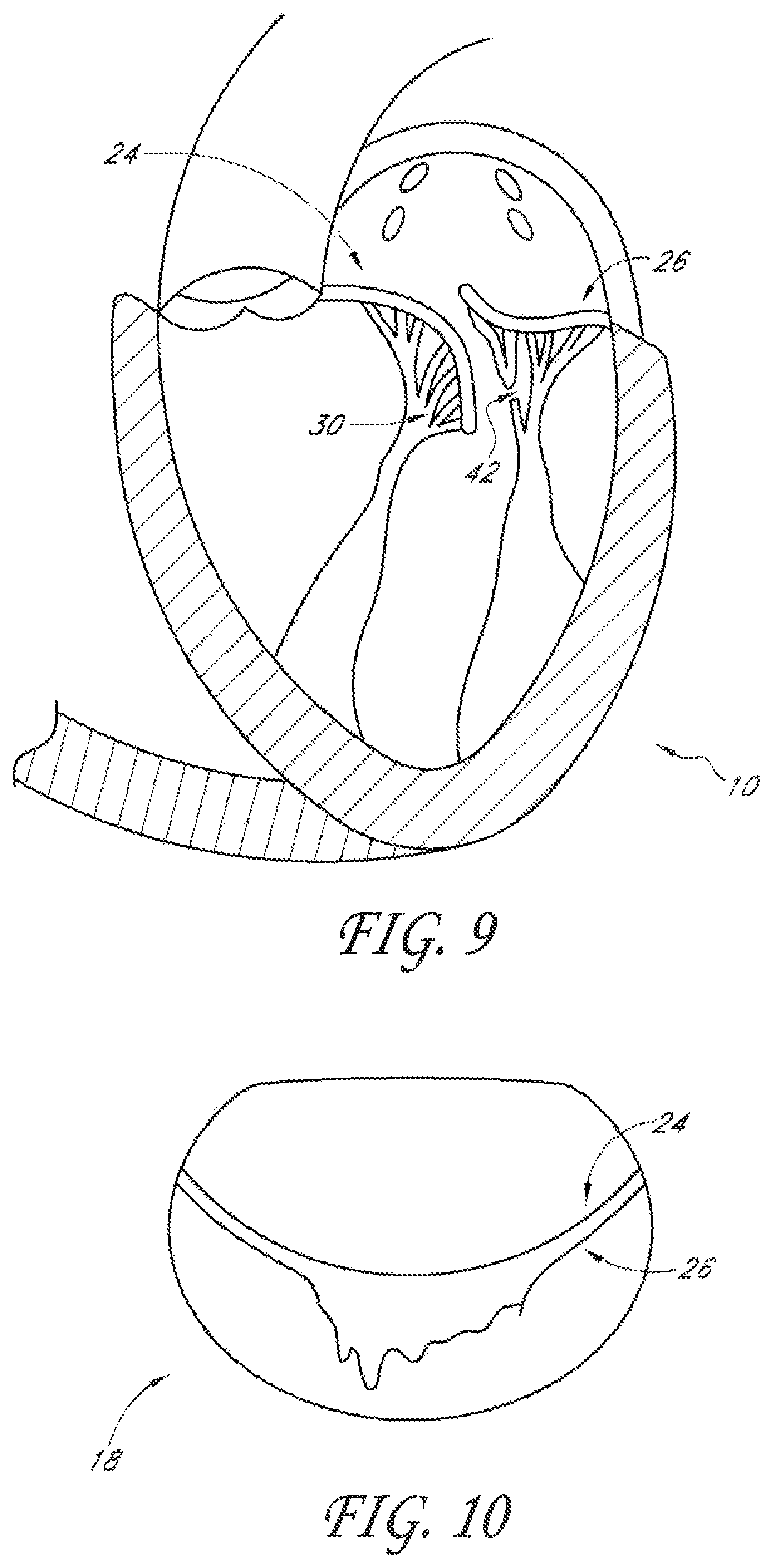 Patent US12588995 Figure 5 – Transvalvular intraanular band and chordae cutting for ischemic and dilated cardiomyopathy