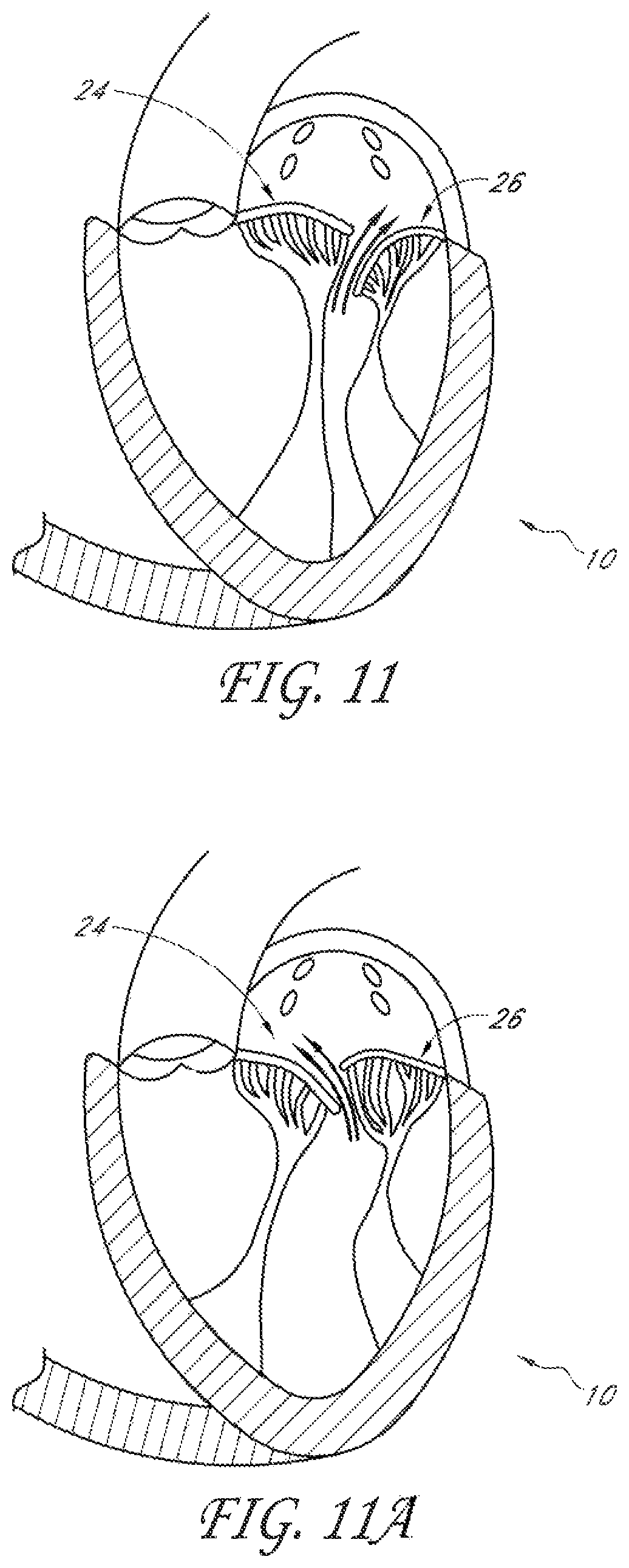 Patent US12588995 Figure 6 – Transvalvular intraanular band and chordae cutting for ischemic and dilated cardiomyopathy