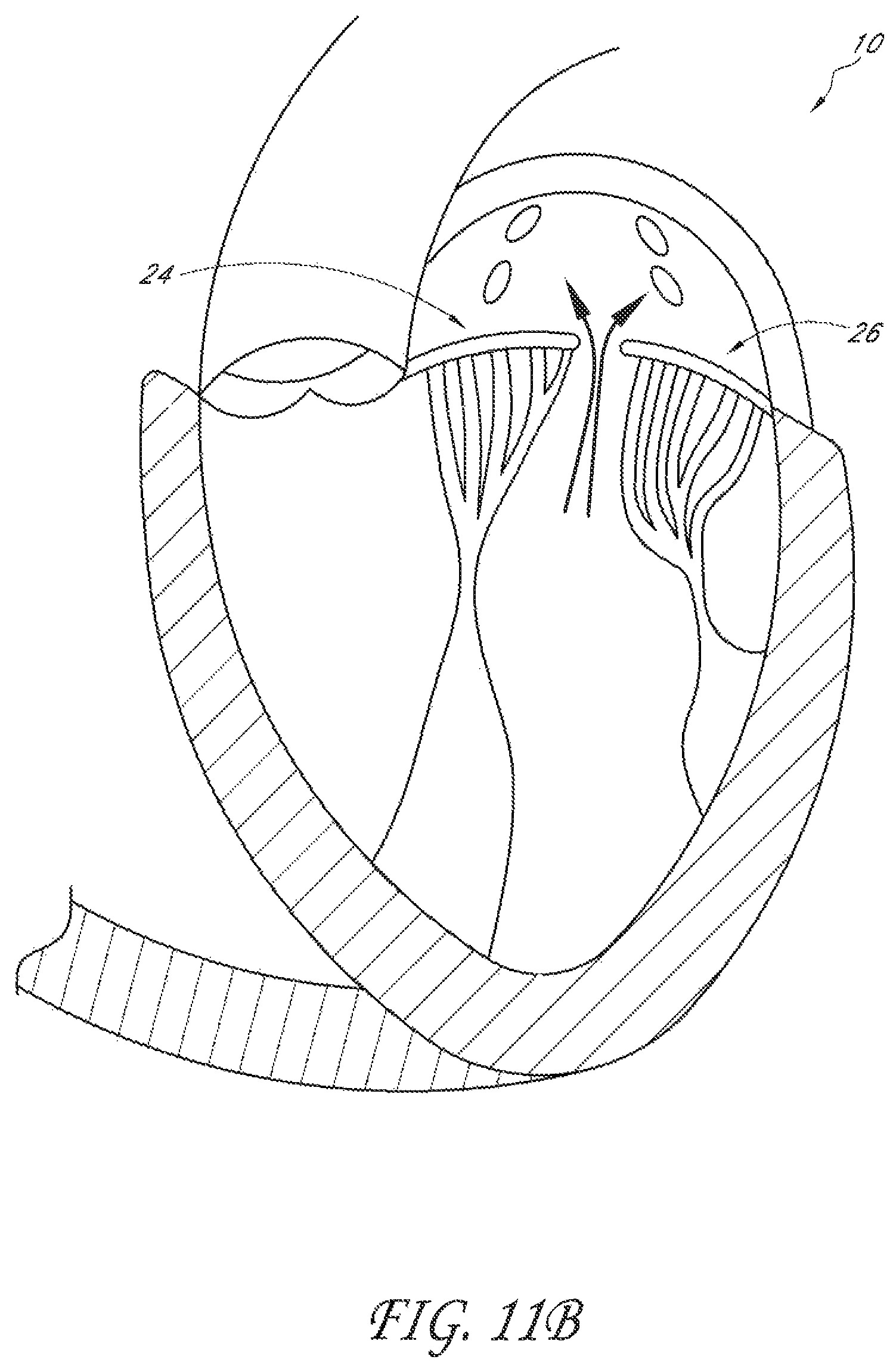 Patent US12588995 Figure 7 – Transvalvular intraanular band and chordae cutting for ischemic and dilated cardiomyopathy