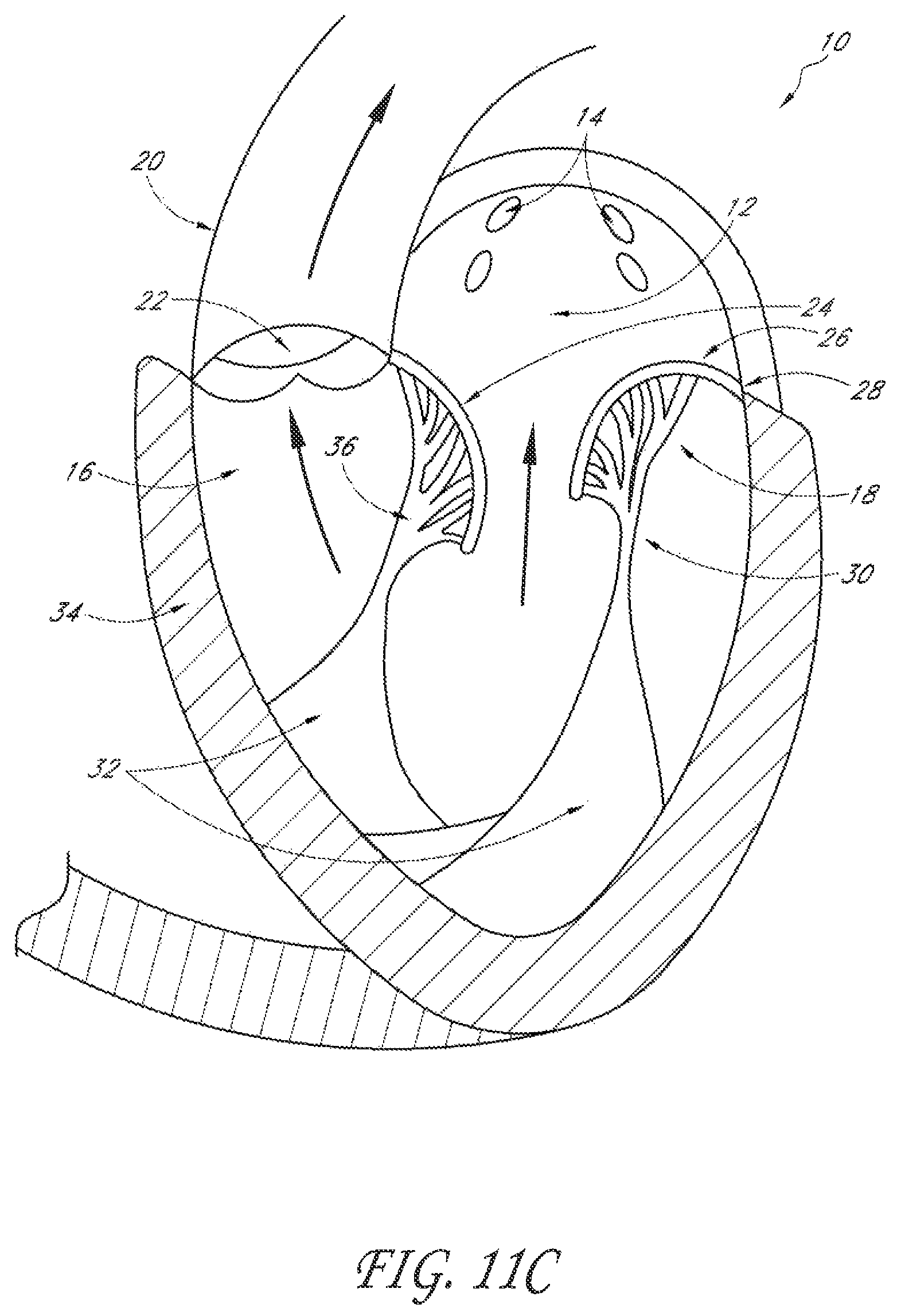 Patent US12588995 Figure 8 – Transvalvular intraanular band and chordae cutting for ischemic and dilated cardiomyopathy