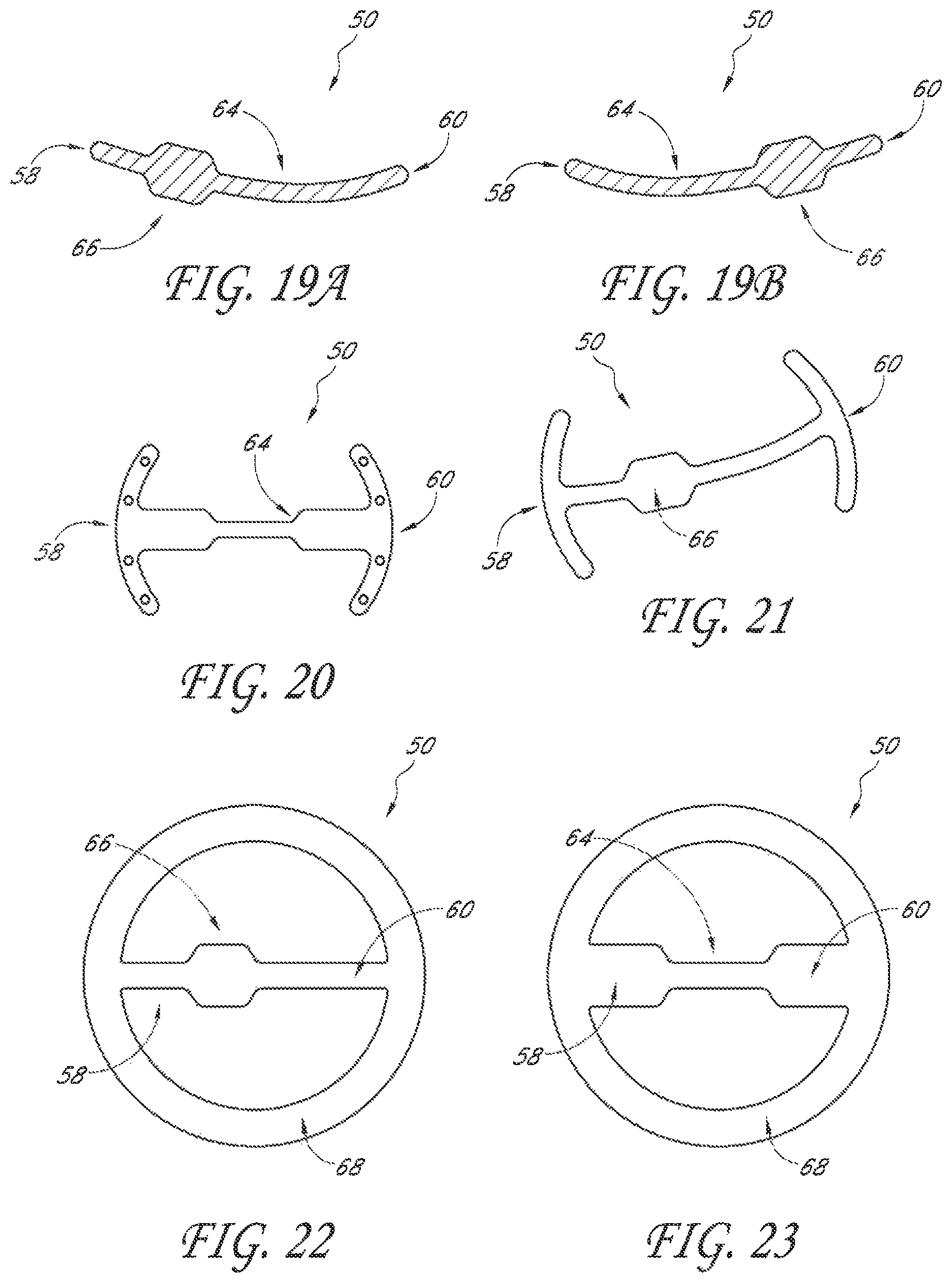 Patent US12588995 Figure 10 – Transvalvular intraanular band and chordae cutting for ischemic and dilated cardiomyopathy