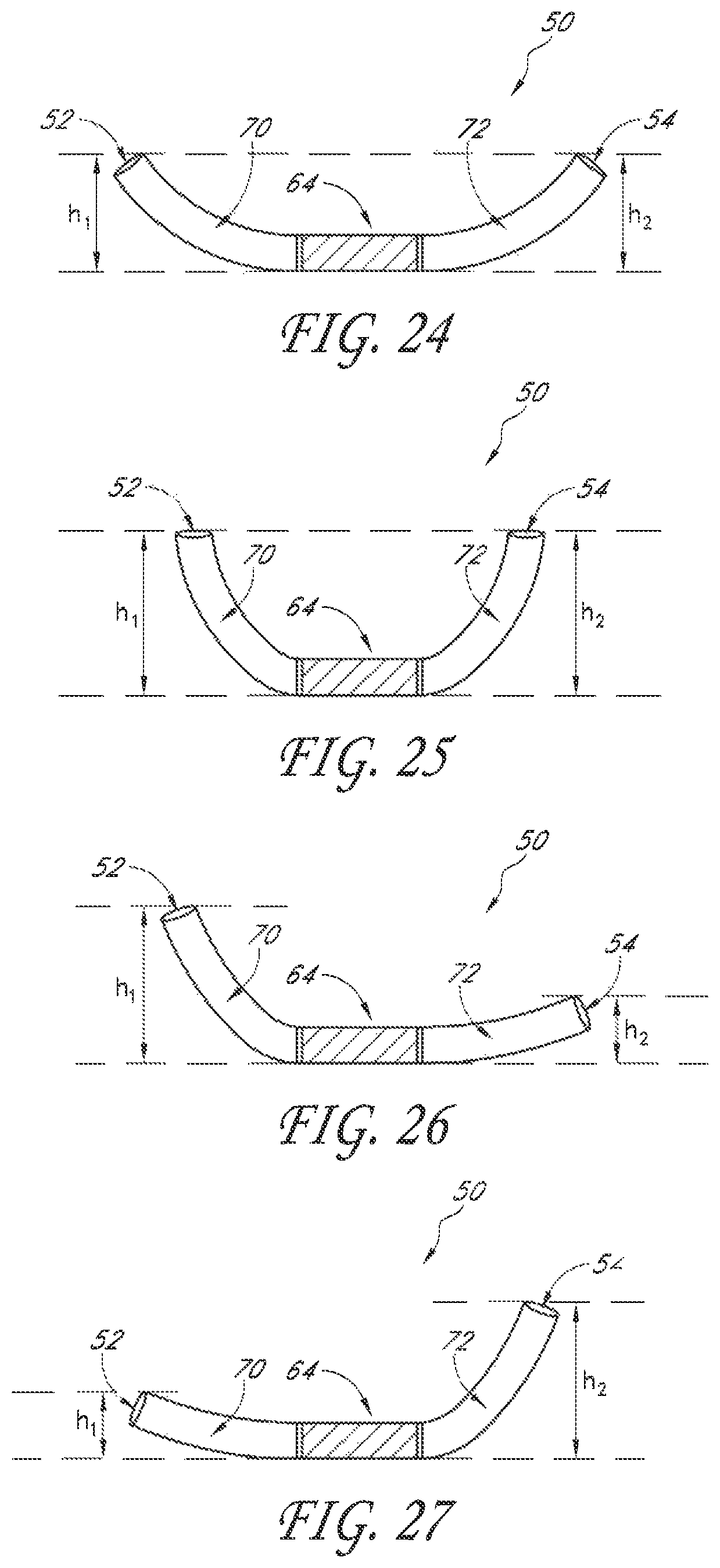 Patent US12588995 Figure 12 – Transvalvular intraanular band and chordae cutting for ischemic and dilated cardiomyopathy