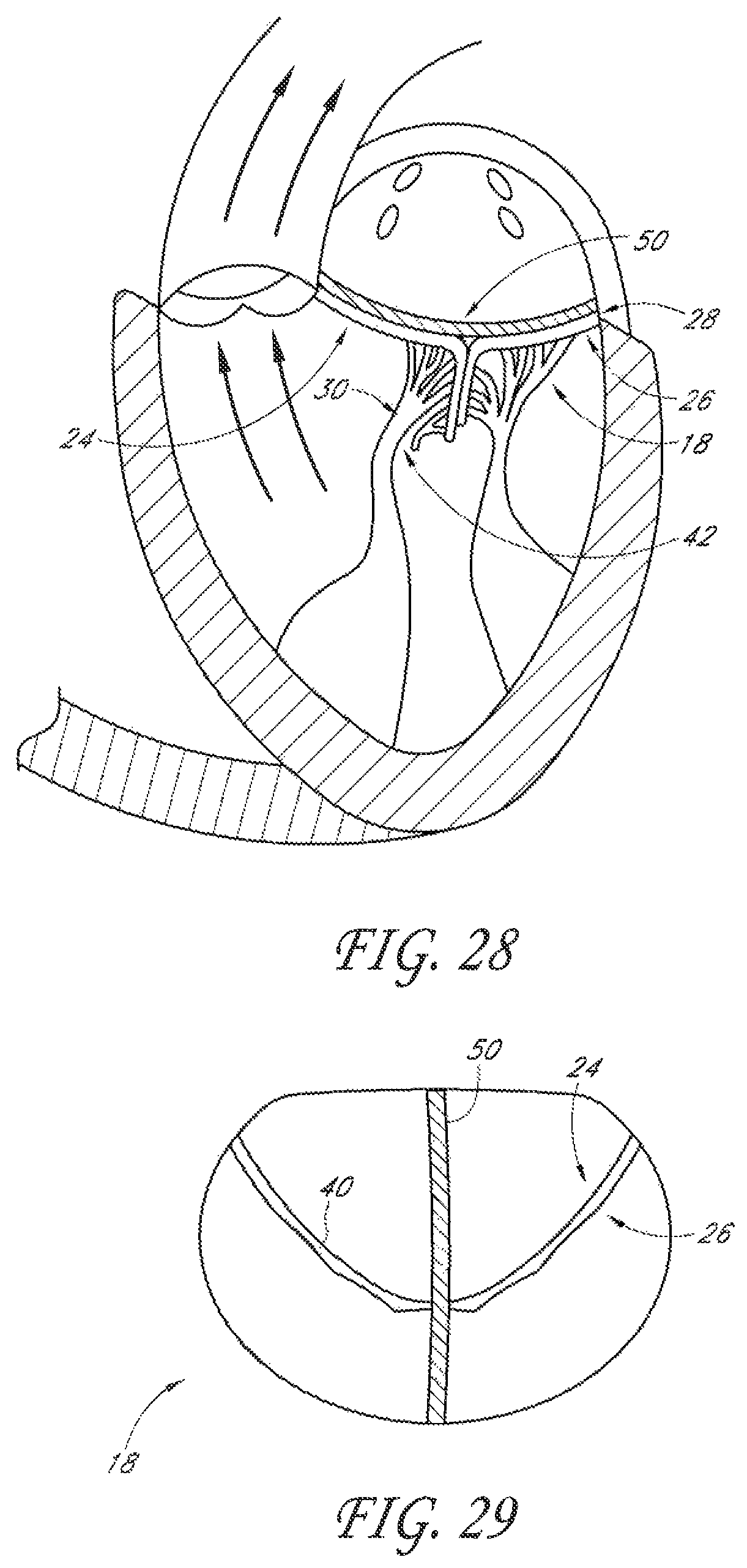 Patent US12588995 Figure 13 – Transvalvular intraanular band and chordae cutting for ischemic and dilated cardiomyopathy