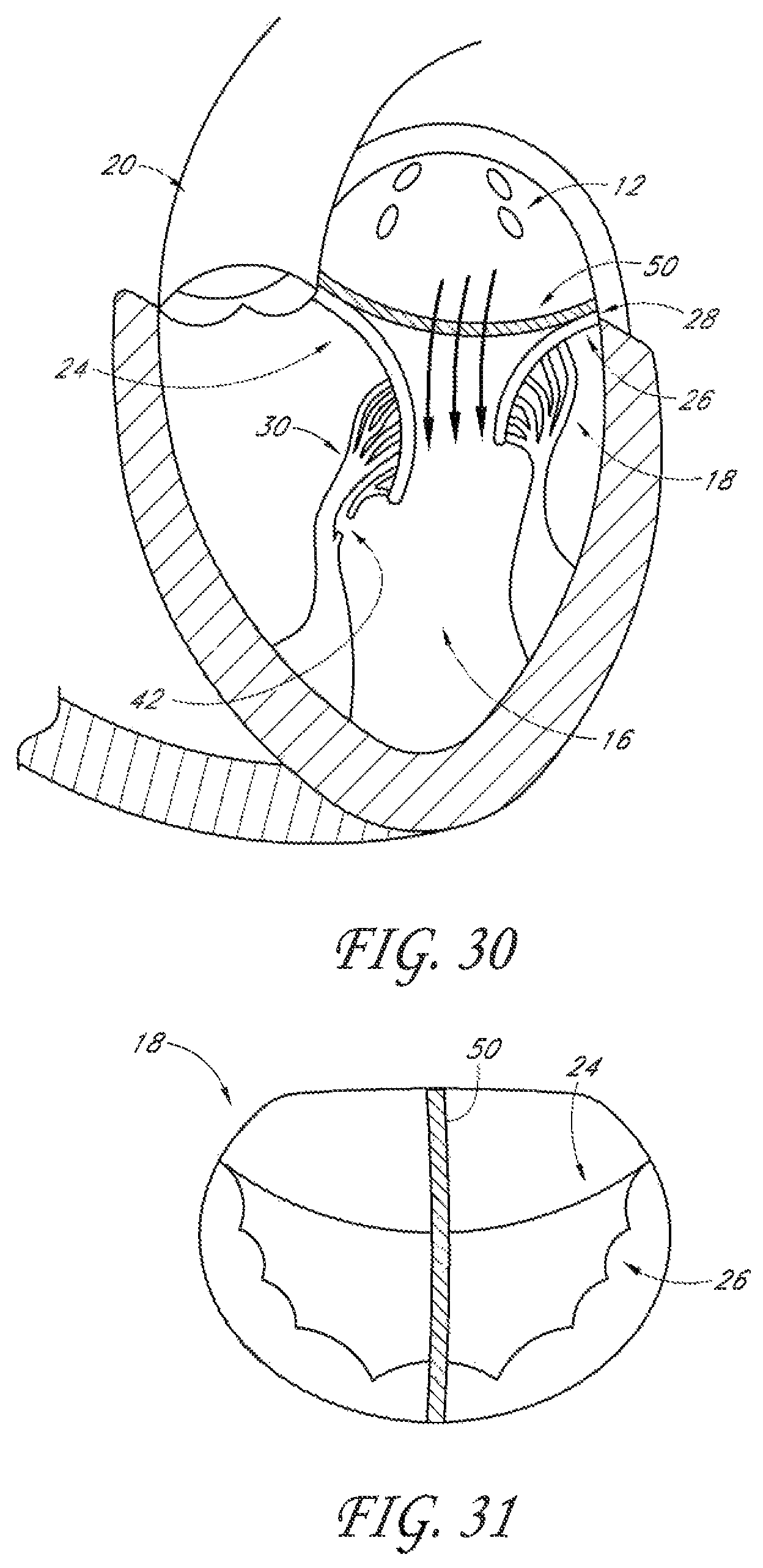 Patent US12588995 Figure 14 – Transvalvular intraanular band and chordae cutting for ischemic and dilated cardiomyopathy