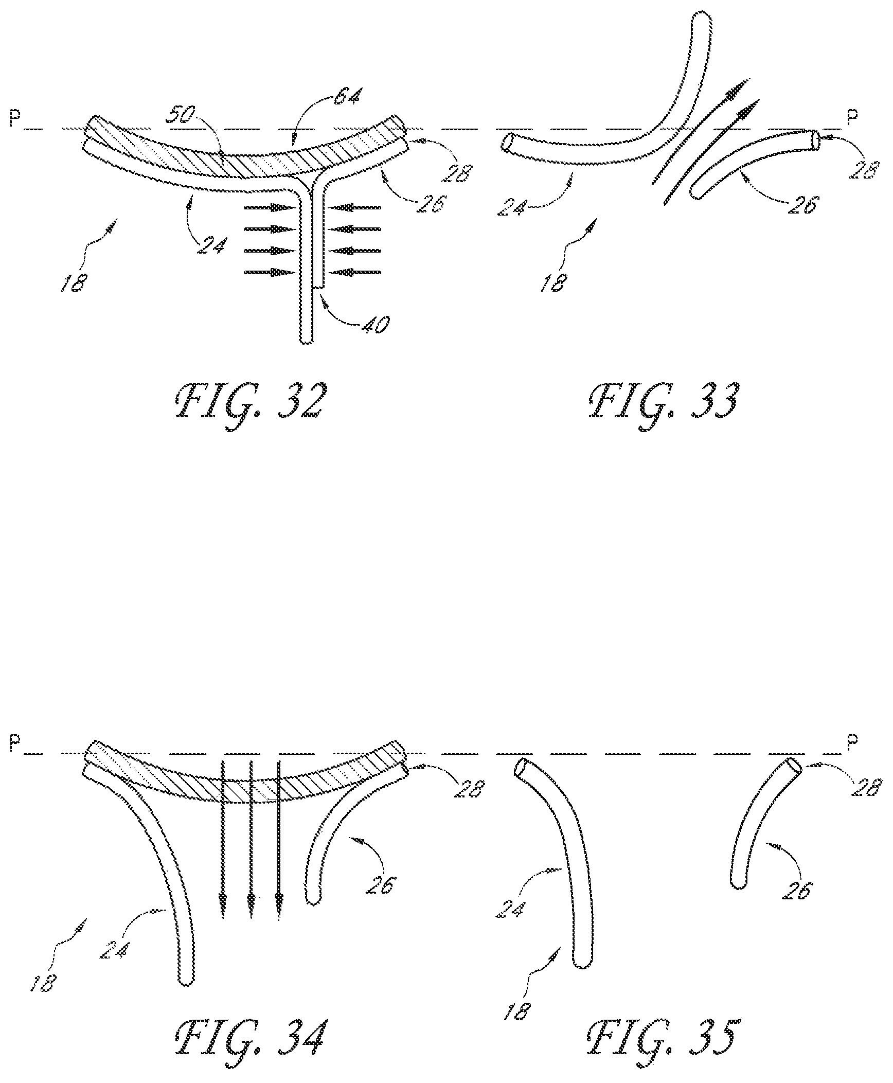 Patent US12588995 Figure 15 – Transvalvular intraanular band and chordae cutting for ischemic and dilated cardiomyopathy