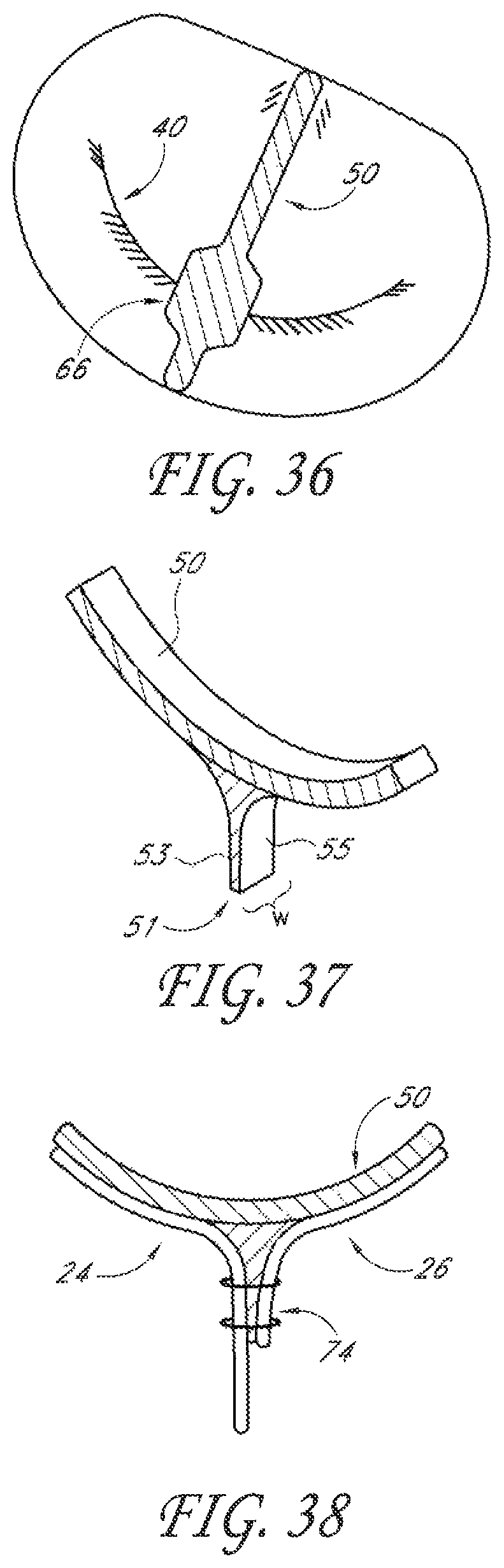 Patent US12588995 Figure 16 – Transvalvular intraanular band and chordae cutting for ischemic and dilated cardiomyopathy