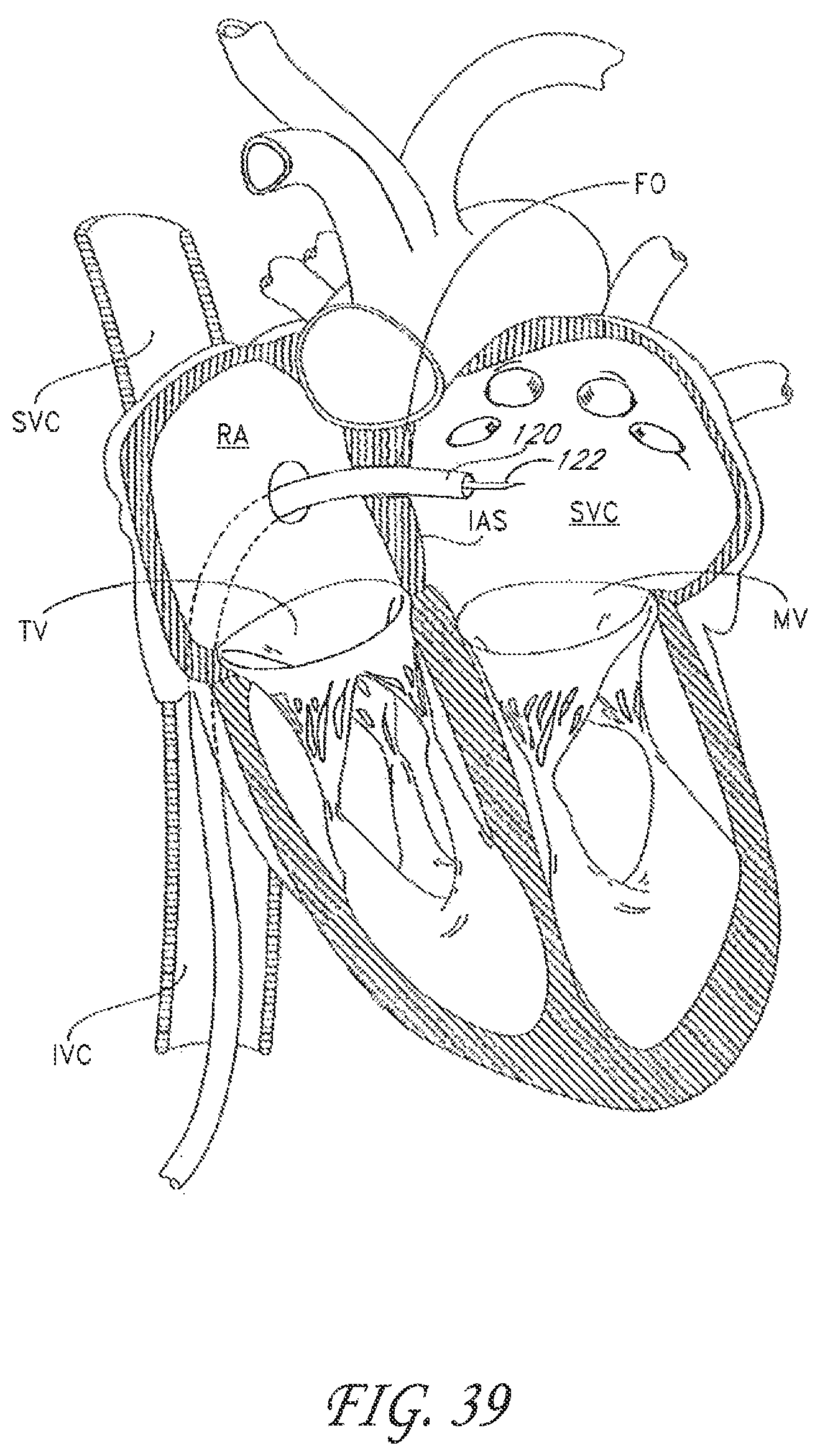 Patent US12588995 Figure 17 – Transvalvular intraanular band and chordae cutting for ischemic and dilated cardiomyopathy