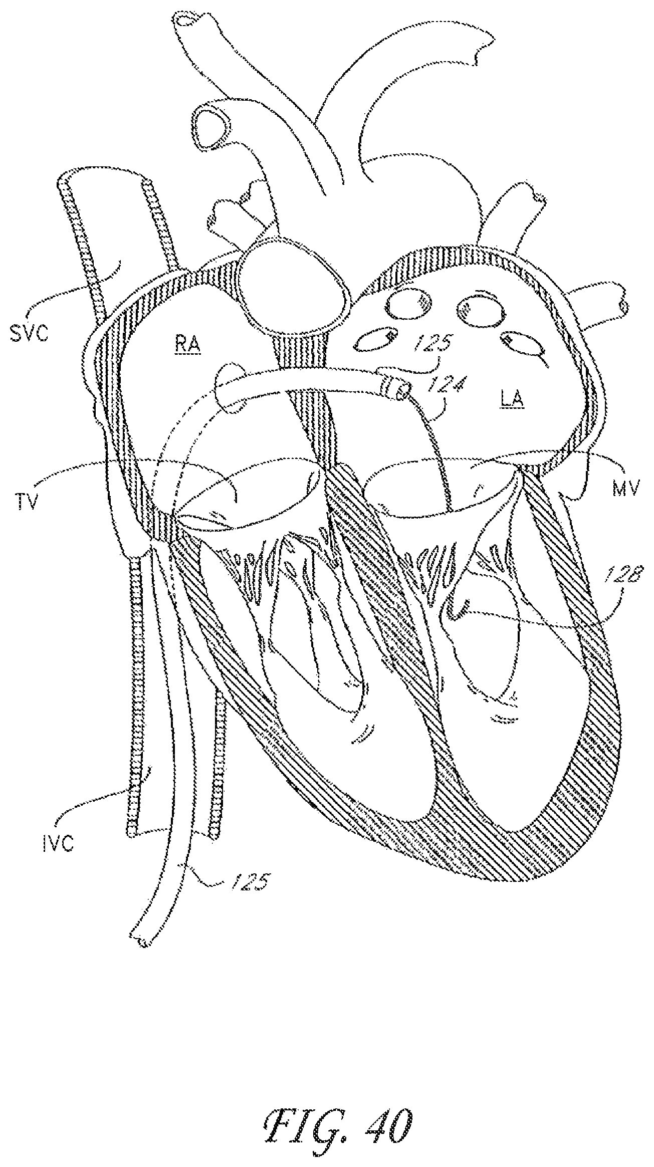 Patent US12588995 Figure 18 – Transvalvular intraanular band and chordae cutting for ischemic and dilated cardiomyopathy