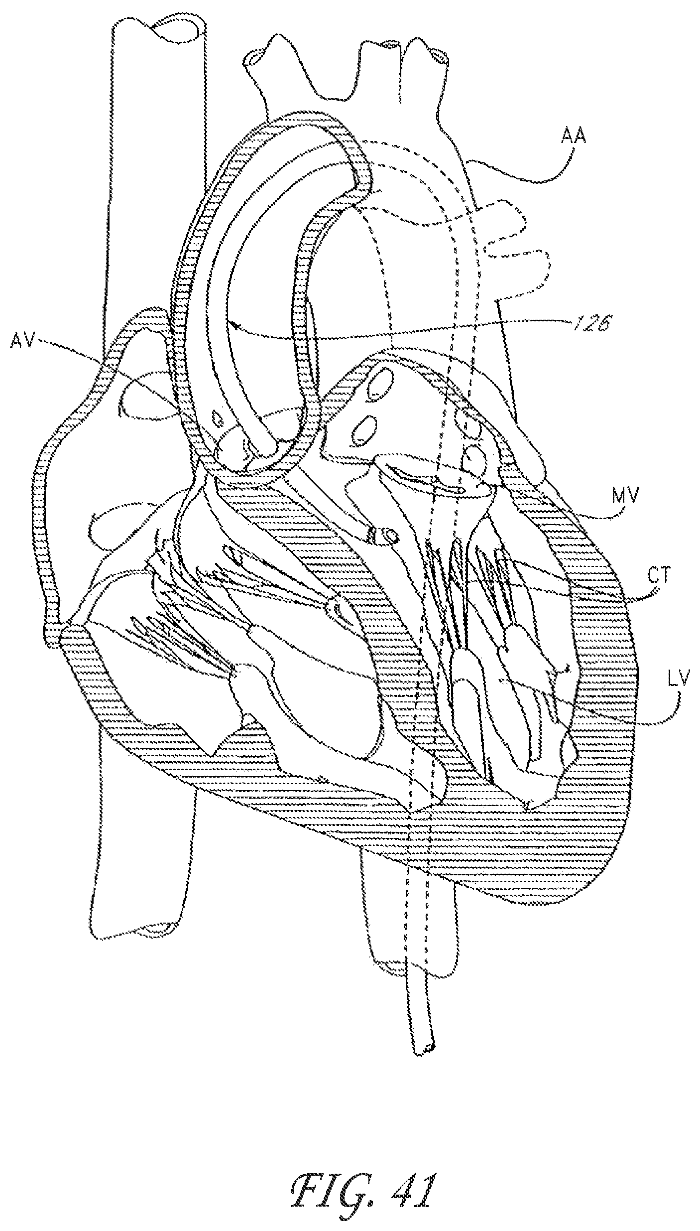 Patent US12588995 Figure 19 – Transvalvular intraanular band and chordae cutting for ischemic and dilated cardiomyopathy