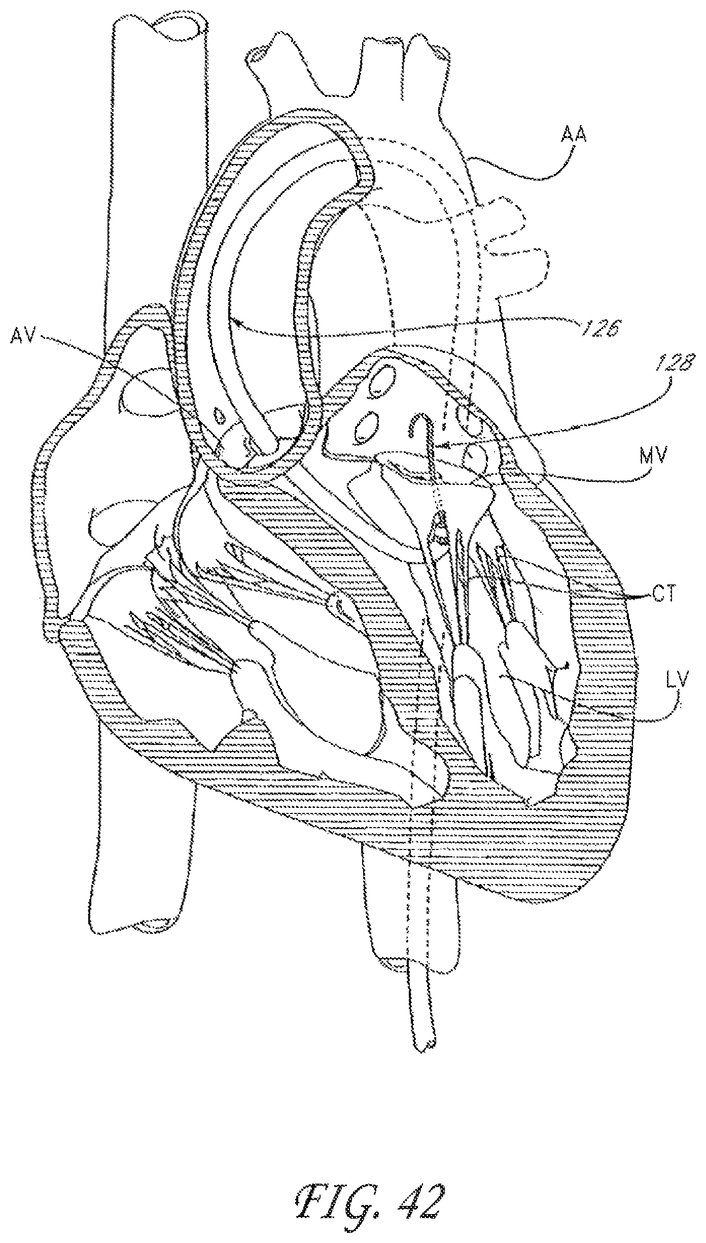 Patent US12588995 Figure 20 – Transvalvular intraanular band and chordae cutting for ischemic and dilated cardiomyopathy