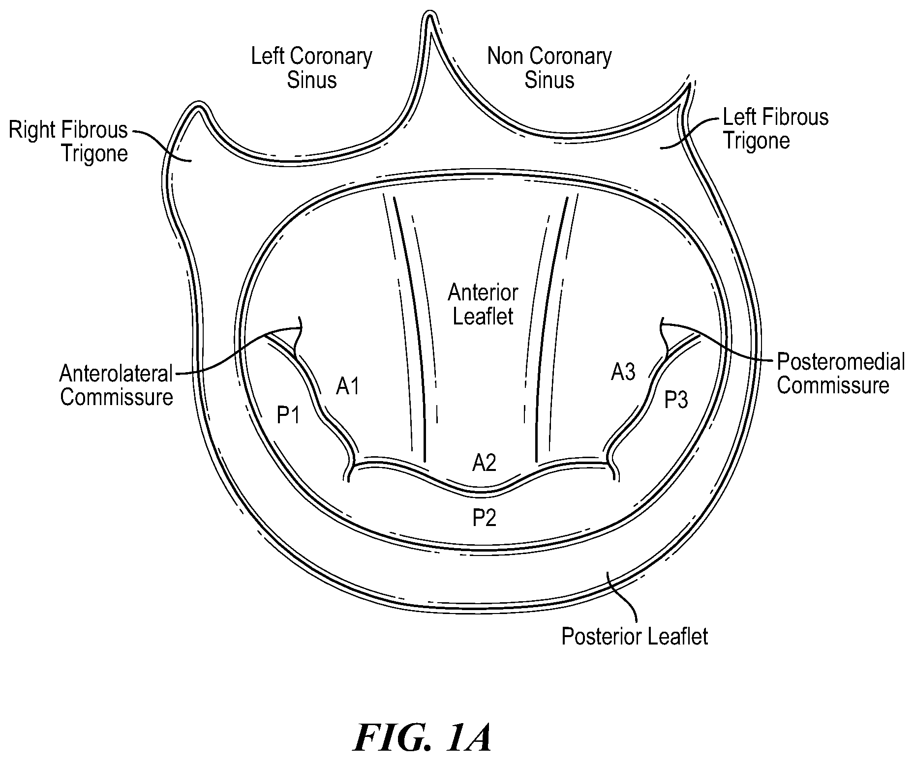 Patent US12588996 Figure 1 – Cardiac valve repair devices and associated systems and methods