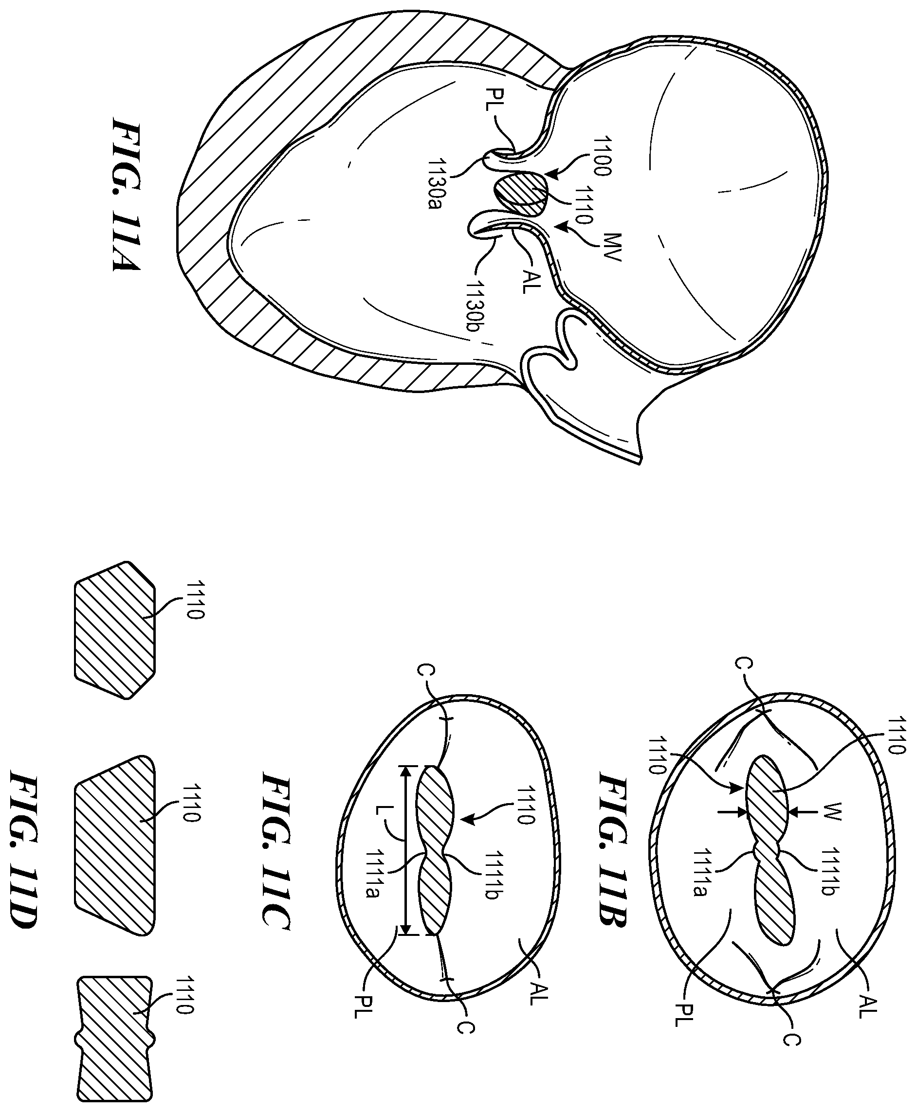 Patent US12588996 Figure 13 – Cardiac valve repair devices and associated systems and methods