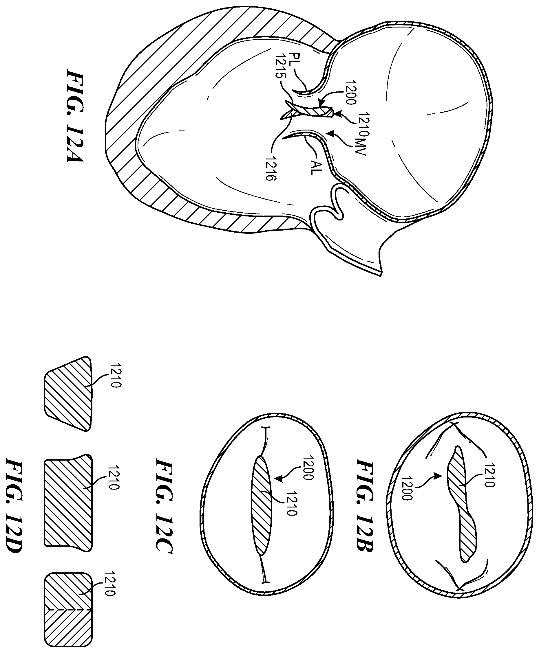 Patent US12588996 Figure 14 – Cardiac valve repair devices and associated systems and methods