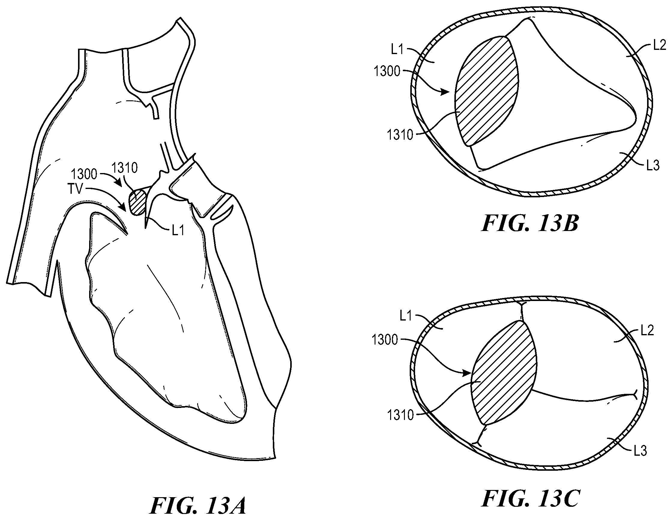 Patent US12588996 Figure 15 – Cardiac valve repair devices and associated systems and methods